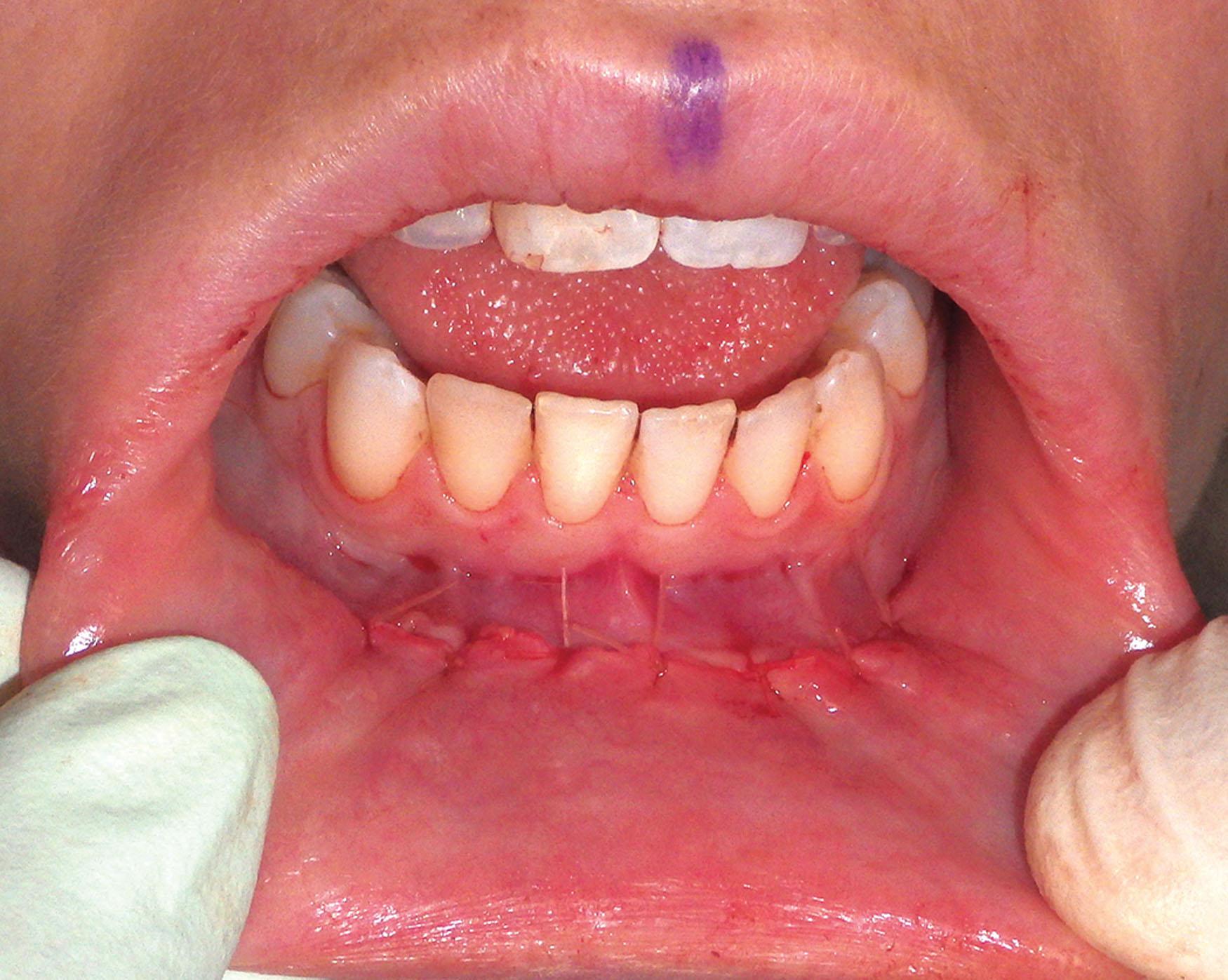 Fig. 7.63, Interrupted 4-0 gut mucosal sutures are shown. This is not a watertight closure and allows drainage if there is fluid buildup.