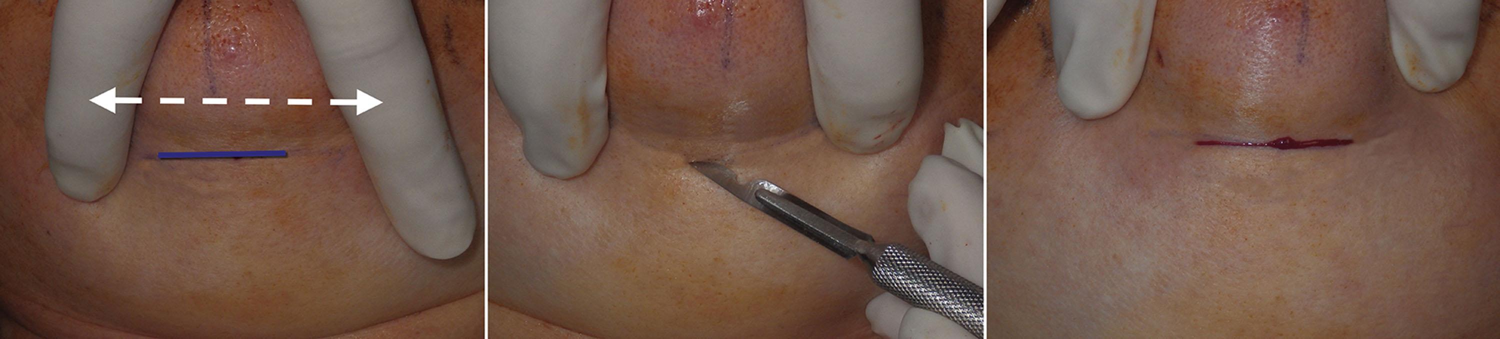 Fig. 7.68, Placing the incision on lateral stretch by making a V with the fingers assists the surgeon in making a straight horizontal incision.