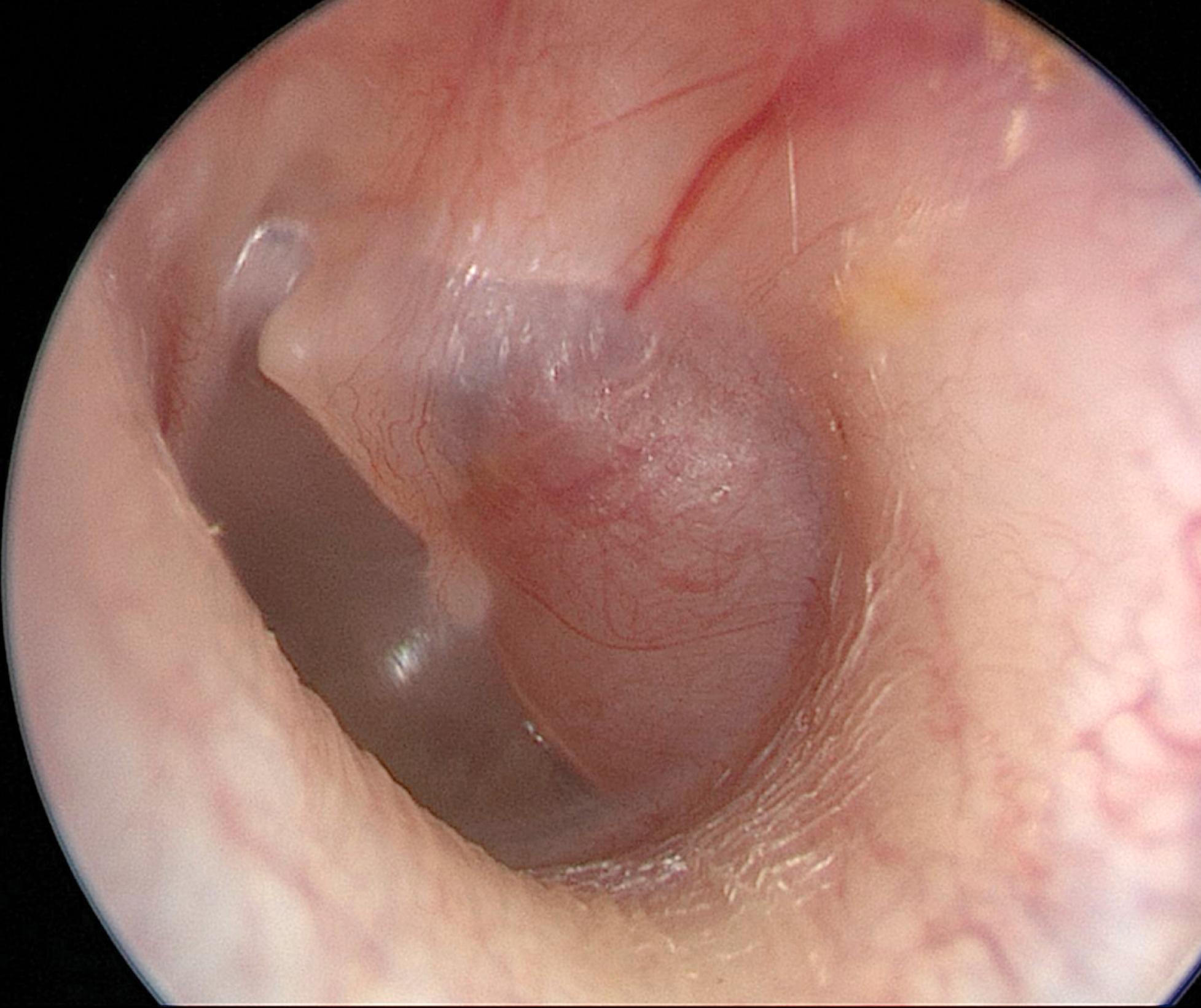 Fig. 28.1, A white posteriorly located retrotympanic mass should raise suspicion for facial nerve schwannomas.