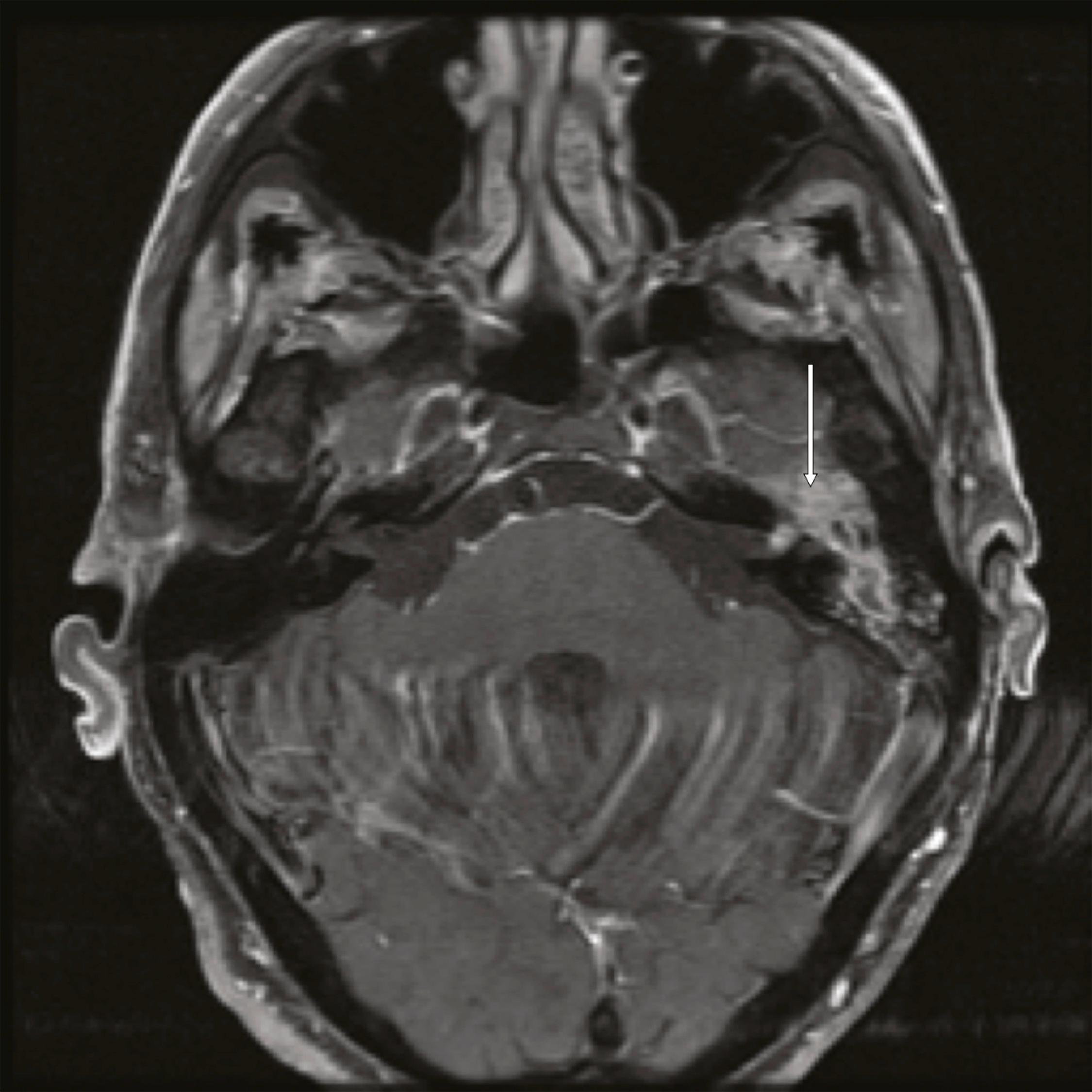 Fig. 28.2, Involvement of the facial nerve by a cutaneous malignancy.