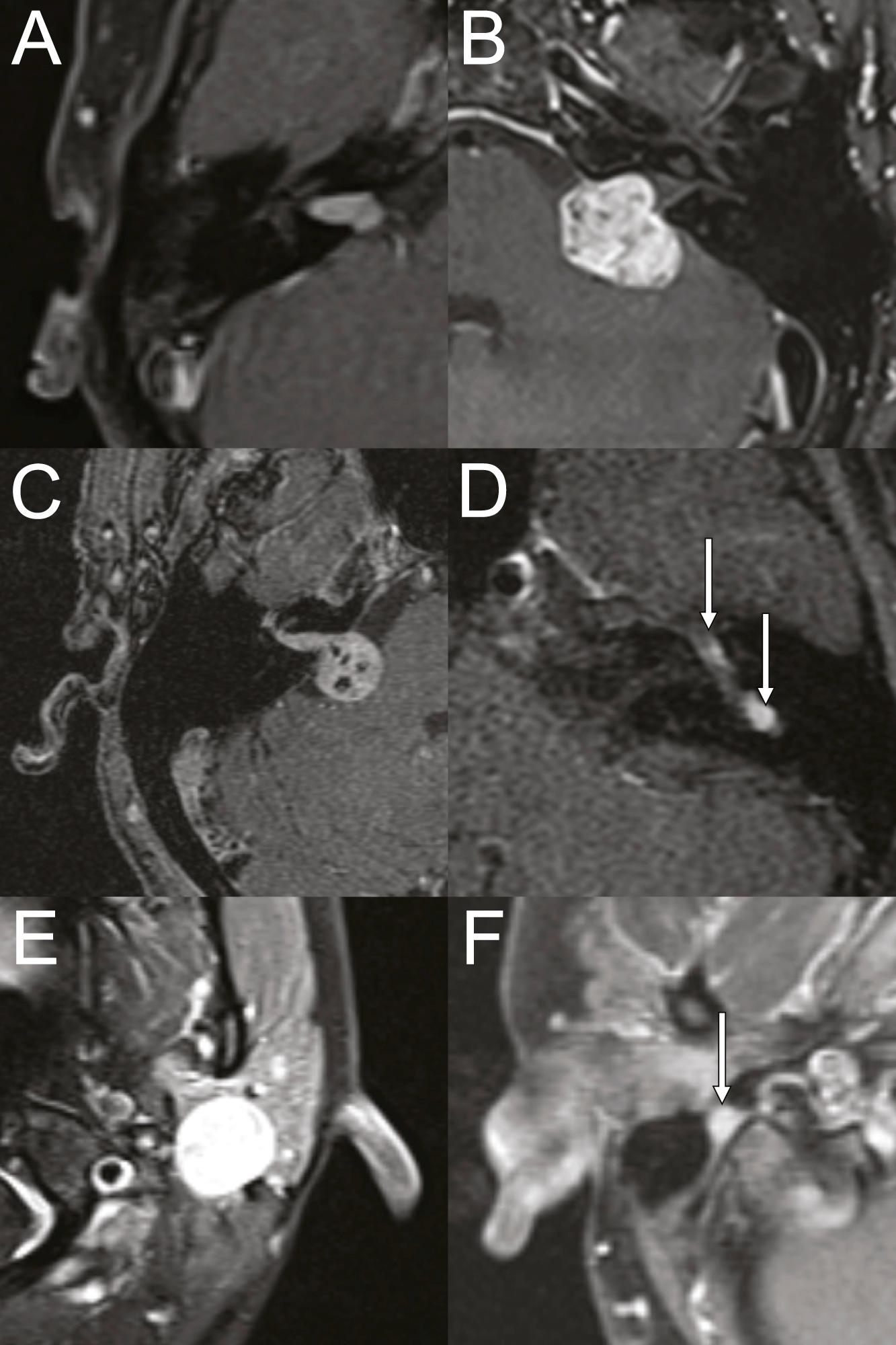 Fig. 28.3, Magnetic resonance imaging appearance of various facial nerve schwannomas.