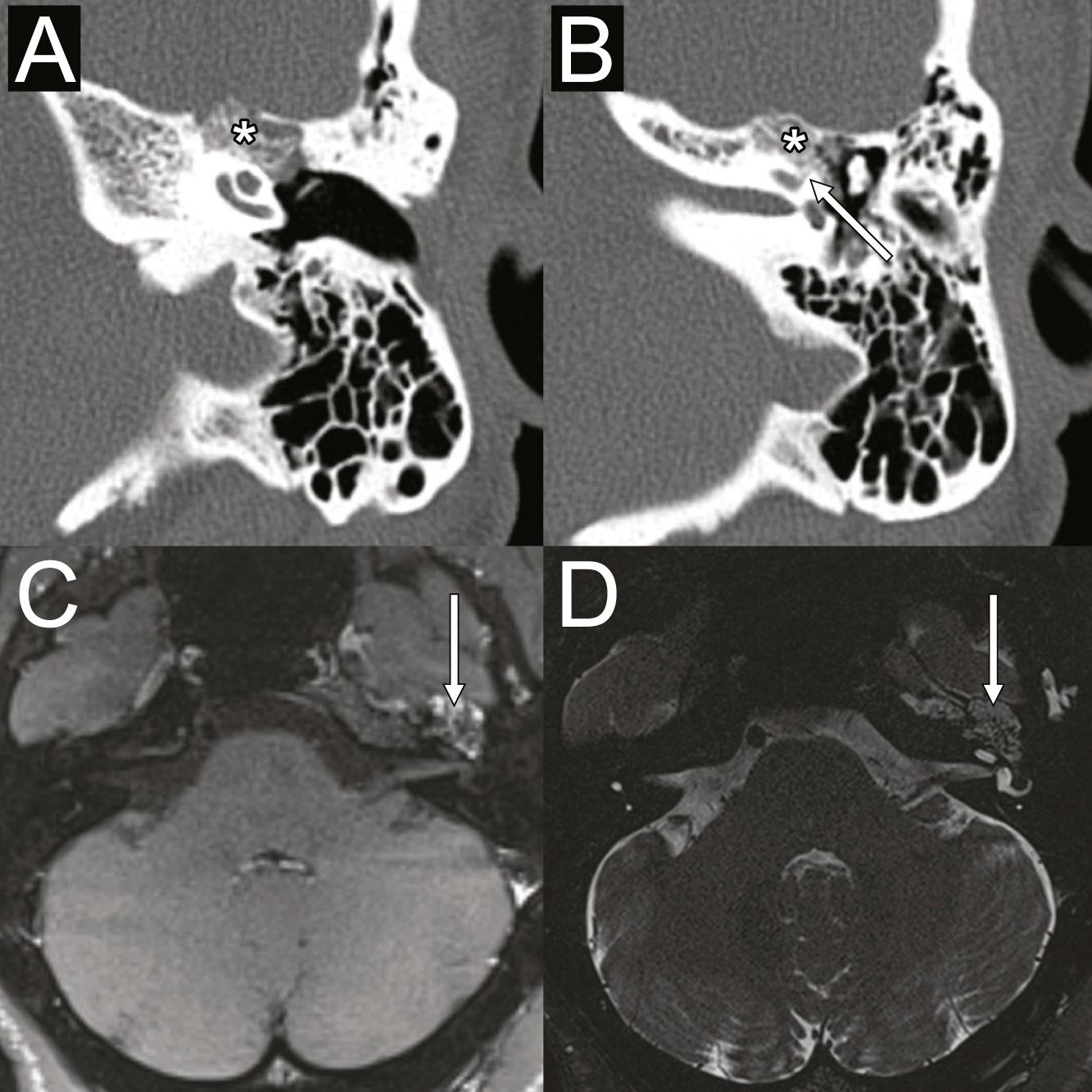 Fig. 28.4, Computed tomographic (A and B) and MRI (C and D, white arrow ) scan showing a hemangioma at the geniculate ganglion with honeycomb bone (A and B, asterisk ). Note the cochlear fistula (B, white arrow ) that may occur with these lesions.