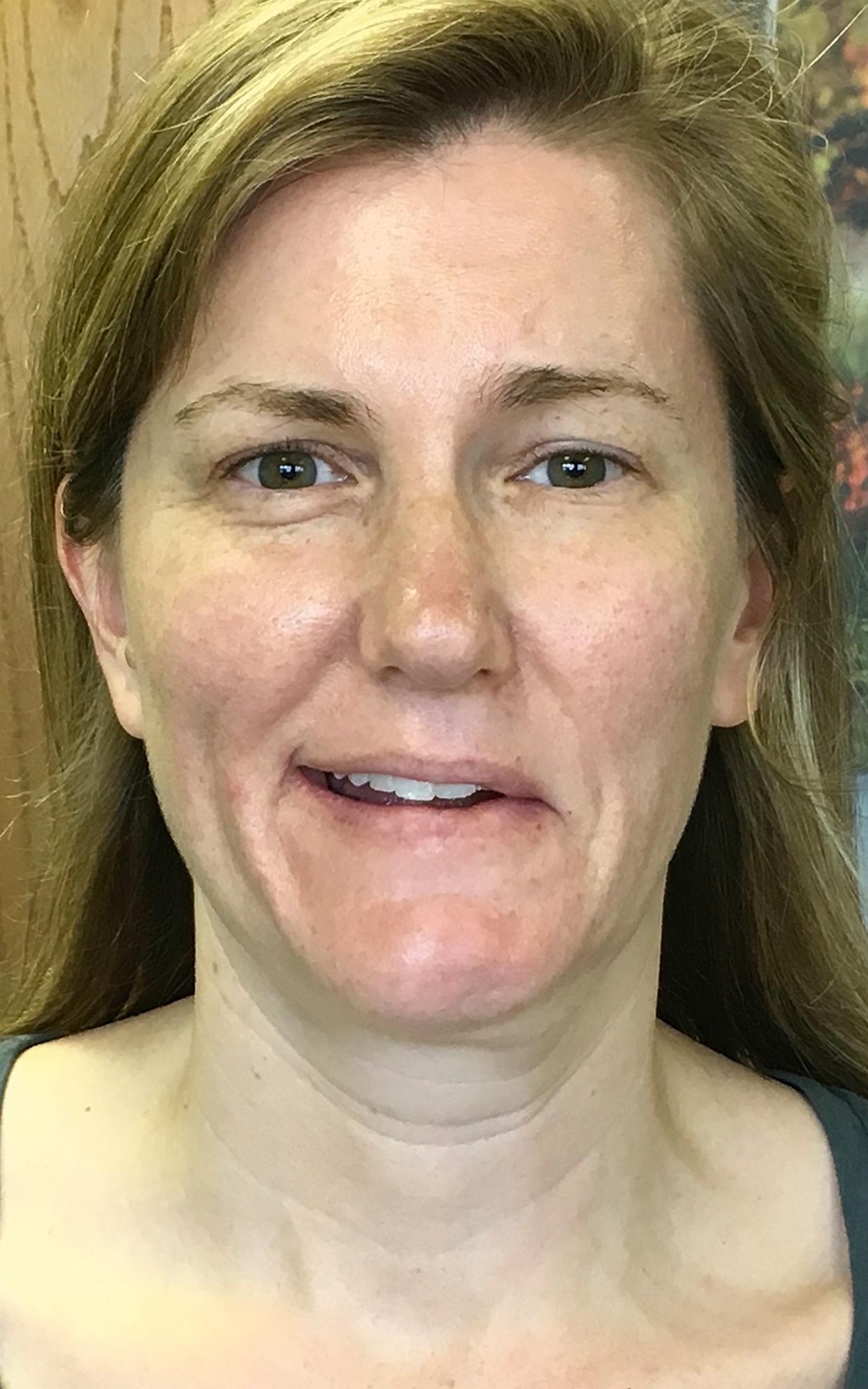 Fig. 9.1, Lack of elevation at the affected left angle of the mouth during smile is visually perceived as weakness of zygomaticus major and minor rather than inability to elevate due to synkinetic co-contraction.
