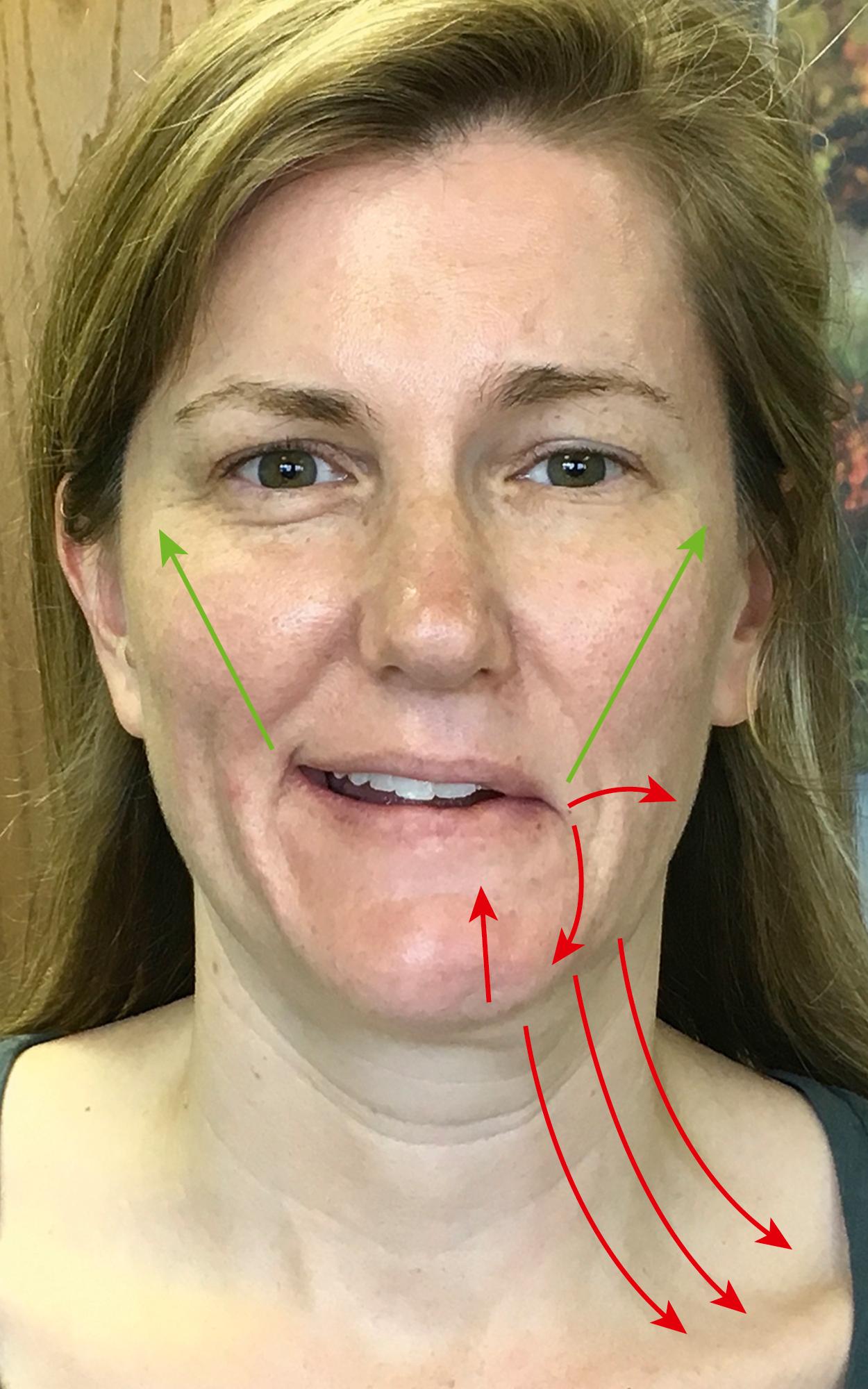 Fig. 9.2, Synkinetic depression/retraction caused by antagonistic co-contraction of ipsilateral depressor anguli oris, buccinator, and platysma (red arrows) while zygomaticus is activated during smile (green arrows).