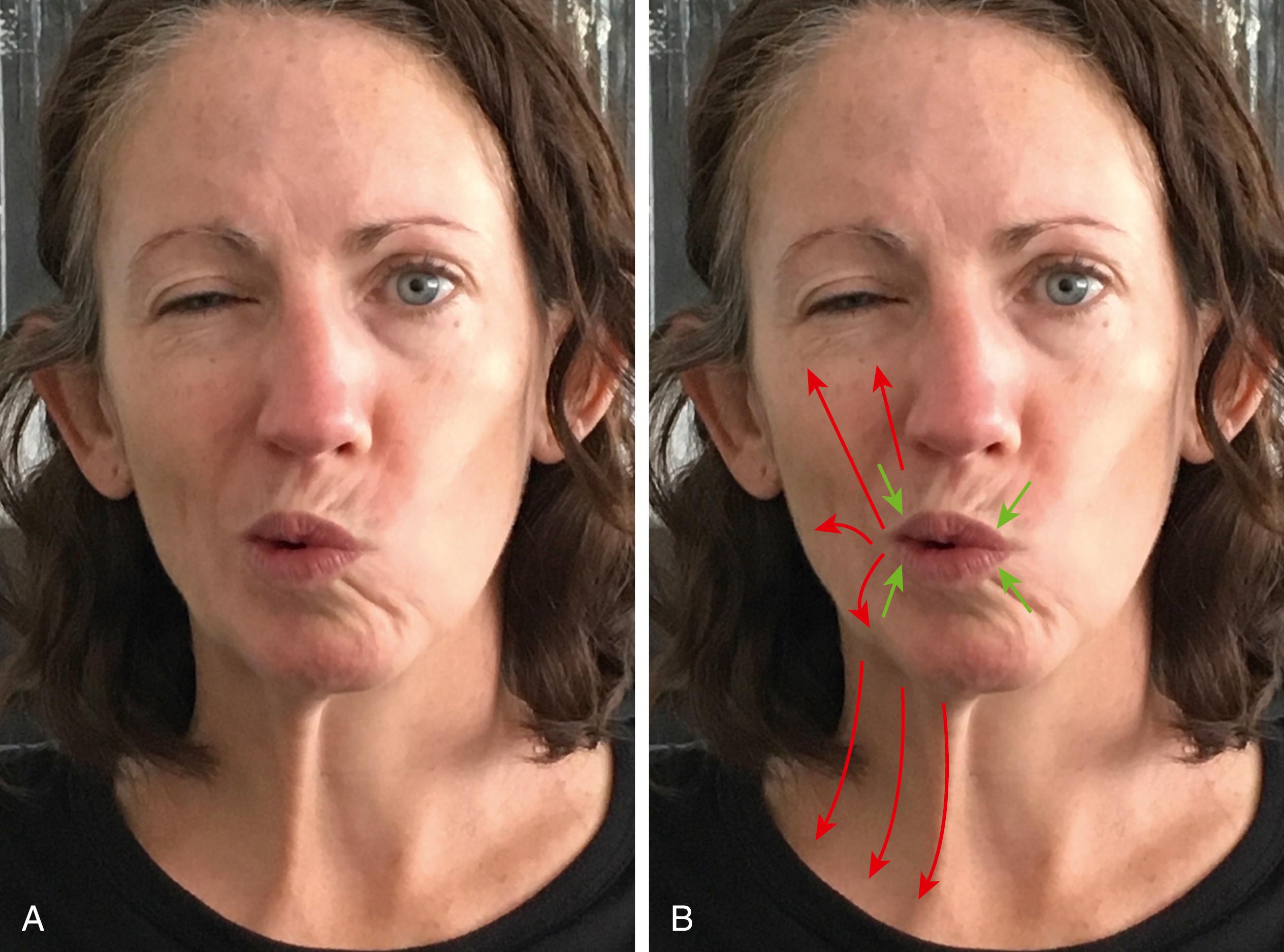 Fig. 9.3, (A, B) During pucker, movement of the lips to midline (orbicularis oris superioris and inferioris [green arrows] ) is restricted by synkinetic co-contraction of opposing muscles, zygomaticus, levators, buccinator, and platysma (red arrows) . Visually it appears as though the lips are weak.