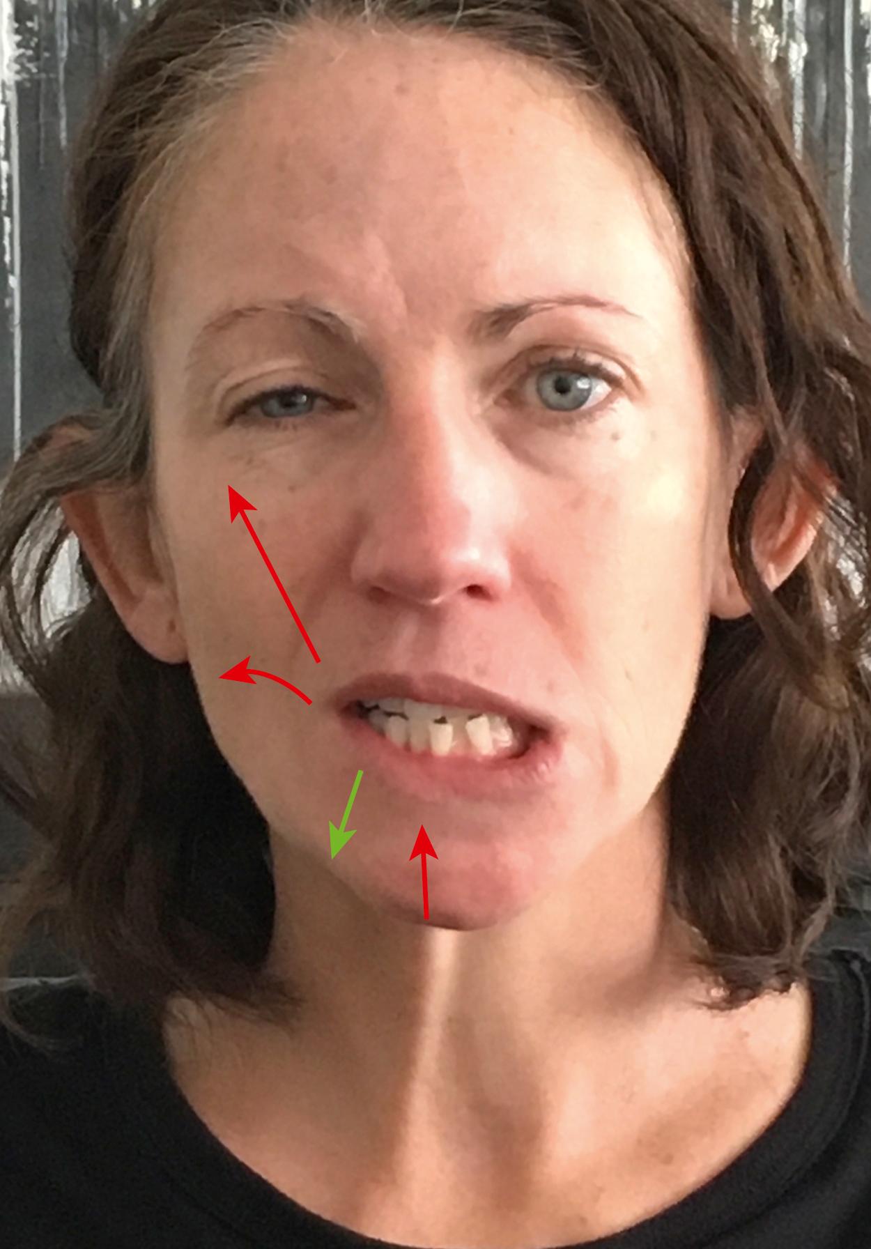 Fig. 9.4, Limited lower lip depression due to synkinetic co-contraction of buccinator and zygomaticus retracting/elevating the lower lip and angle, and mentalis elevating it (red arrows).