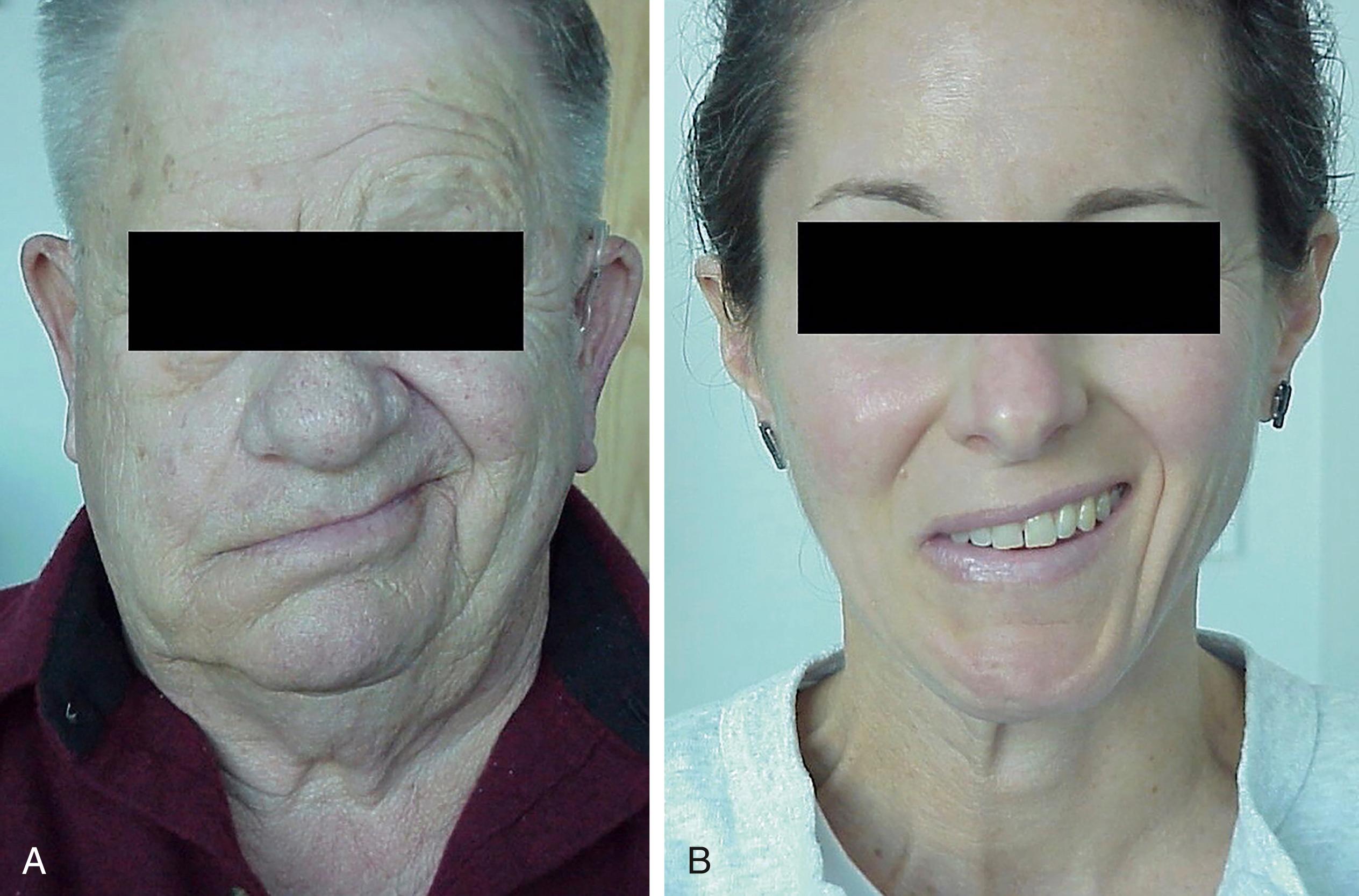 Fig. 9.5, Comparison of Mouth Angle Position in a Flaccid Versus Synkinetic Patient.