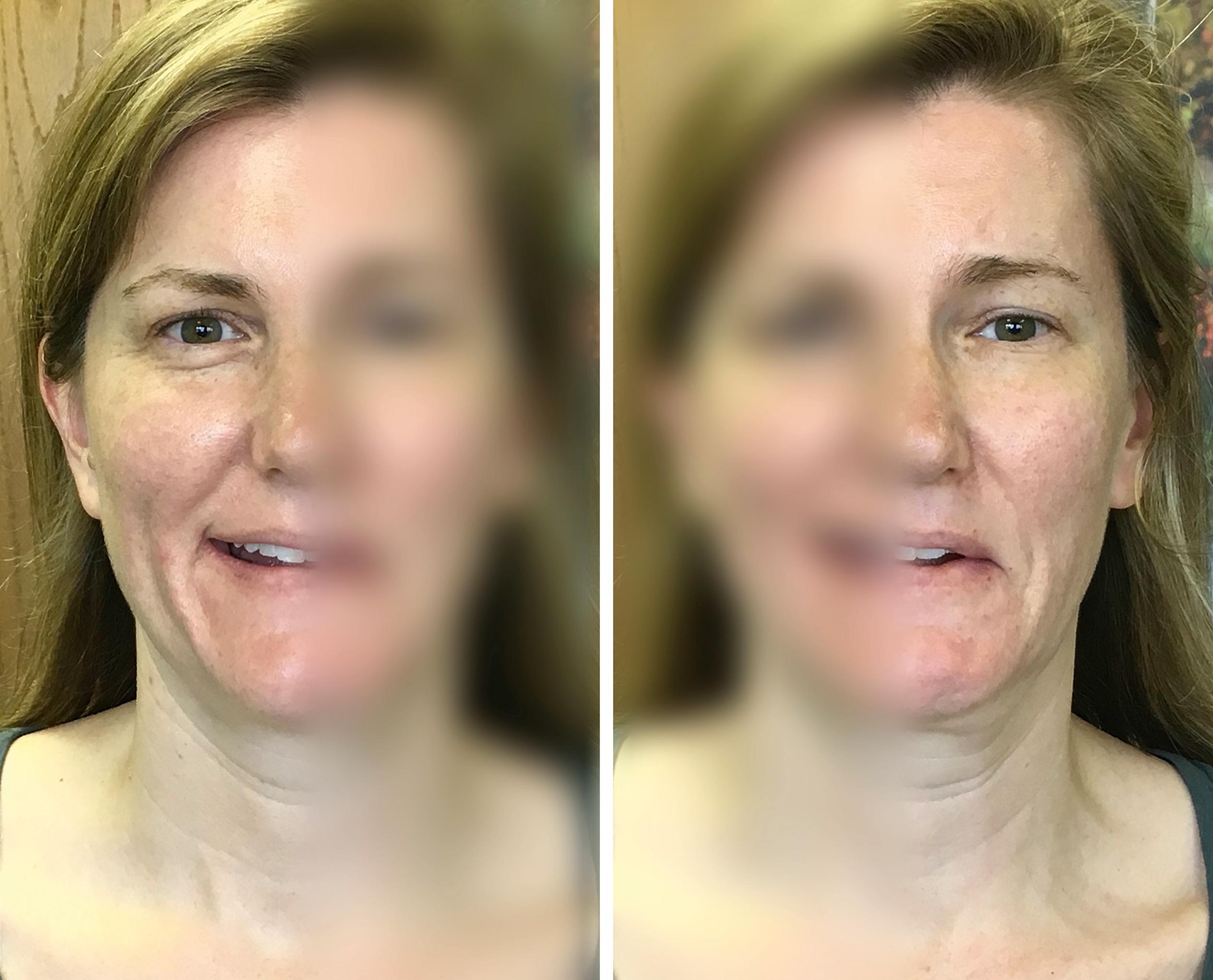 Fig. 9.6, In the synkinetic patient opposing emotional states are communicated simultaneously, confounding nonverbal communication. In this case, the unaffected (right) side communicates happy (zygomaticus), whereas the synkinetic side communicates happy + sad (zygomaticus + depressor anguli oris).