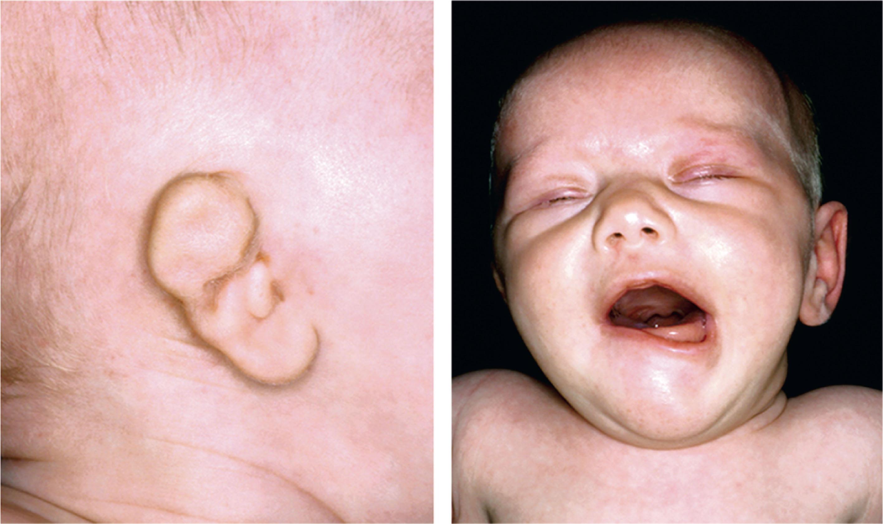 FIGURE 14.2, Right facial nerve palsy in a child with oculoauriculovertebral sequence.