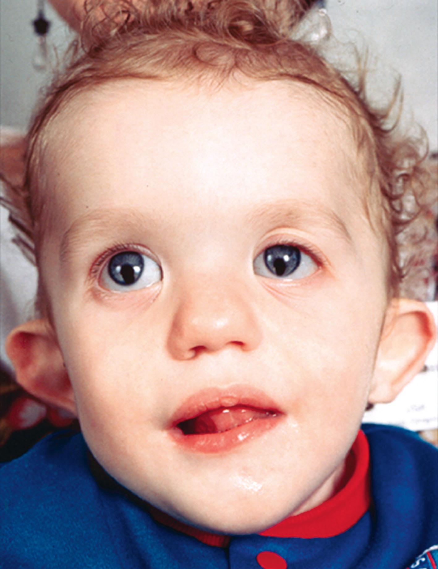 FIGURE 14.3, Child with CHARGE syndrome with right facial weakness, dysplastic ears, and bilateral iris colobomata. This condition is caused by mutations in CHD7 .