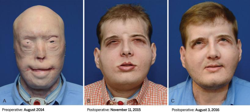 Fig. 3.17.1, Facial transplantation of entire face and scalp soft tissue envelope. (A) Preoperative view; (B) early postoperative view; (C) approximately 1 year postoperatively.