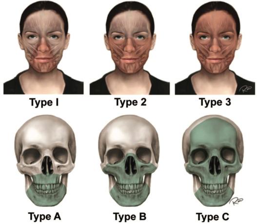 Fig. 3.17.2, Diagram of the classification system for facial transplantation illustrates the extent of each soft tissue (above, shaded red) and bony defect (below, shaded green).
