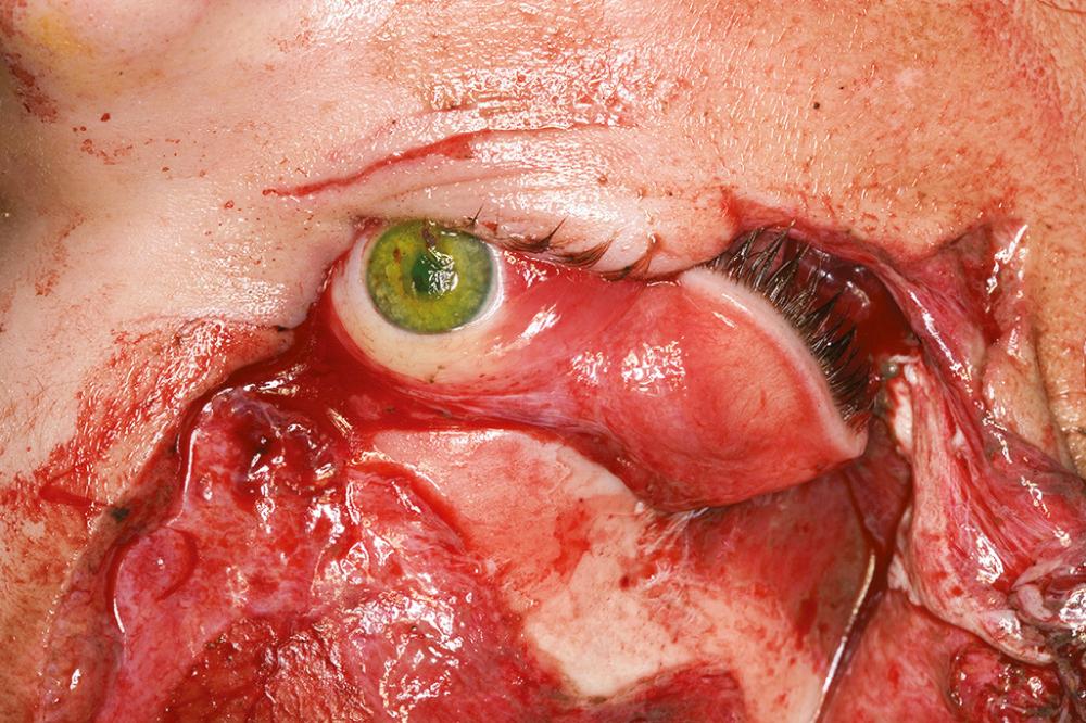 Fig. 19.1, Complex laceration involving the eyelids results in exposure of the globe.
