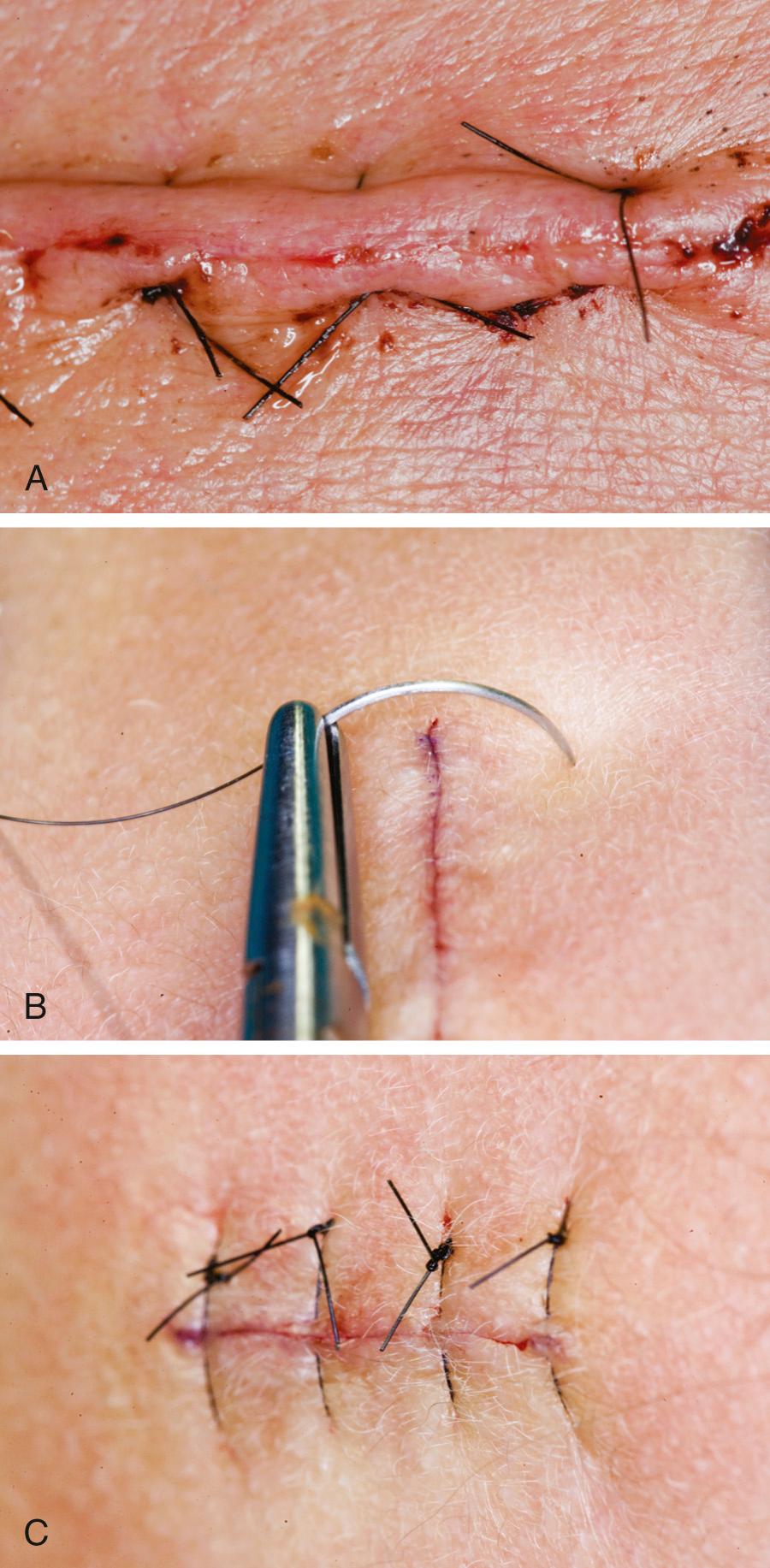 Fig. 19.4, (A) Improperly placed vertical mattress sutures will cause separation of the wound edge and result in suture-track marks. This happens when the far bite is too close to the wound, and the near bite is too far. (B) Properly placed vertical mattress sutures allow the far bite to bisect the chord length of the needle and enter the skin at a 90-degree angle. (C) This results in an everted wound with good approximation of the edges and plenty of skin to support the sutures.