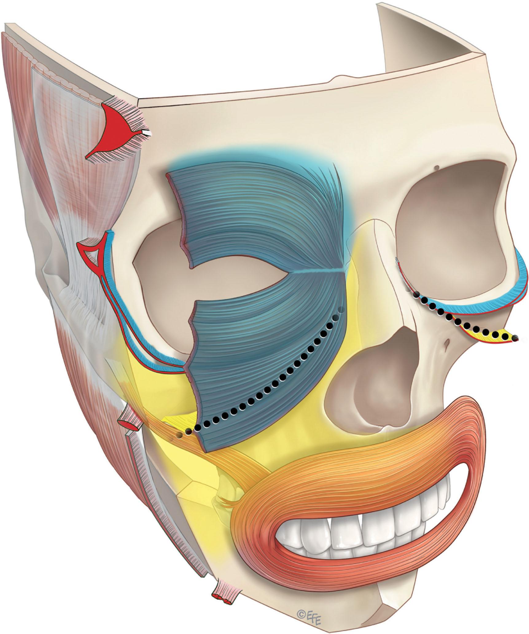 Figure 9.2.1, Regions of the face. The mobile anterior face is separated from the relatively fixed lateral face by a vertical line of ligaments (shown in red). The mobile anterior face is functionally adapted for facial expression while the lateral face passively overlies the masticatory structures. The ligaments are (from above): temporal, lateral orbital, zygomatic, masseteric and mandibular ligaments. The prezygomatic space allows a functional separation of the crowded midcheek structures into two separate but overlapping parts. The orbital-related structures, orbicularis oculi and the orbicularis retaining ligament, are superficial, extending into the roof of the prezygomatic space (shaded blue). The perioral part below is deeper (shaded yellow), where it has a skeletal attachment beneath the floor of the prezygomatic space. These deeply attached perioral structures include the zygomatic muscles and the zygomatic ligaments.