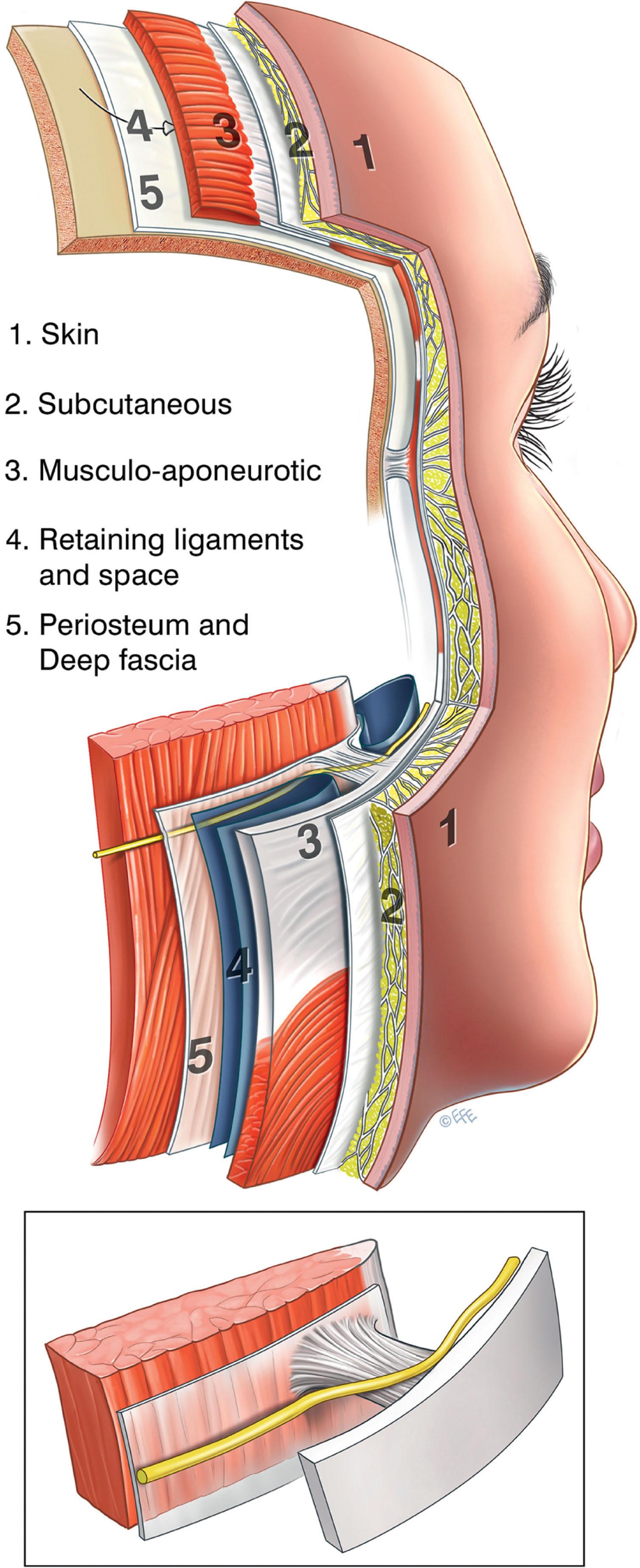 Figure 9.2.2, The basic five-layered construct of the facial soft tissues is most readily understood in the scalp. While this same construct continues over the entire face, for functional purposes there are significant regional modifications. Layer 4, the most variable layer, contains soft tissue spaces alternating with retaining ligaments. In addition, the facial nerve branches travel through layer 4, where they remain outside the spaces and then ascend to layer 3 in close relationship with retaining ligaments. (Inset) . Showing the facial nerve branches ascend across layer 4 where they are under the protection of a ligament.