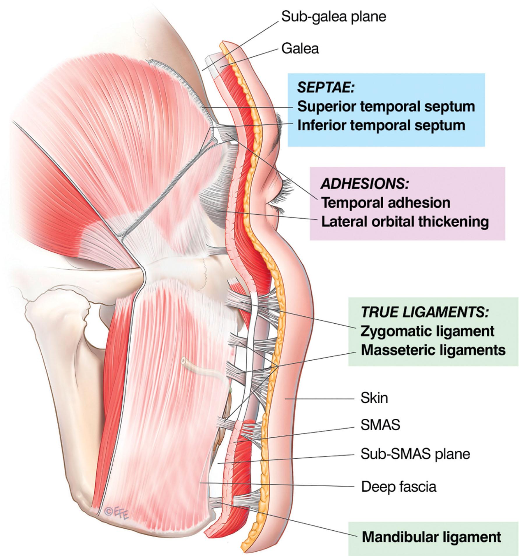 Figure 9.2.4, The retaining ligaments of the face appear in three morphological forms: true ligaments, septae and areas of adhesion.