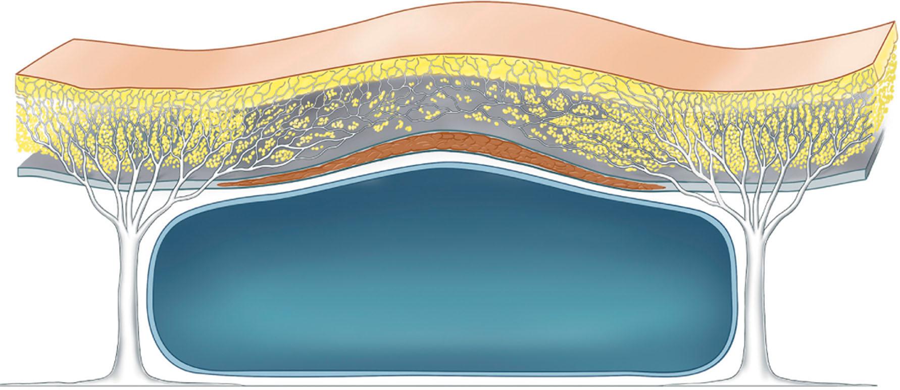 Figure 9.2.5, The effective strength of the retinacular cutis fibers varies in different areas of the face. Overlying the retaining ligaments, the fibers are more vertically orientated, more densely arranged and resist aging changes. Whereas, overlying a space the retinacula fibers are more horizontal and less dense. This structure allows the mobility required for muscle contraction, but the less supported roof over the spaces is prone to laxity with aging.