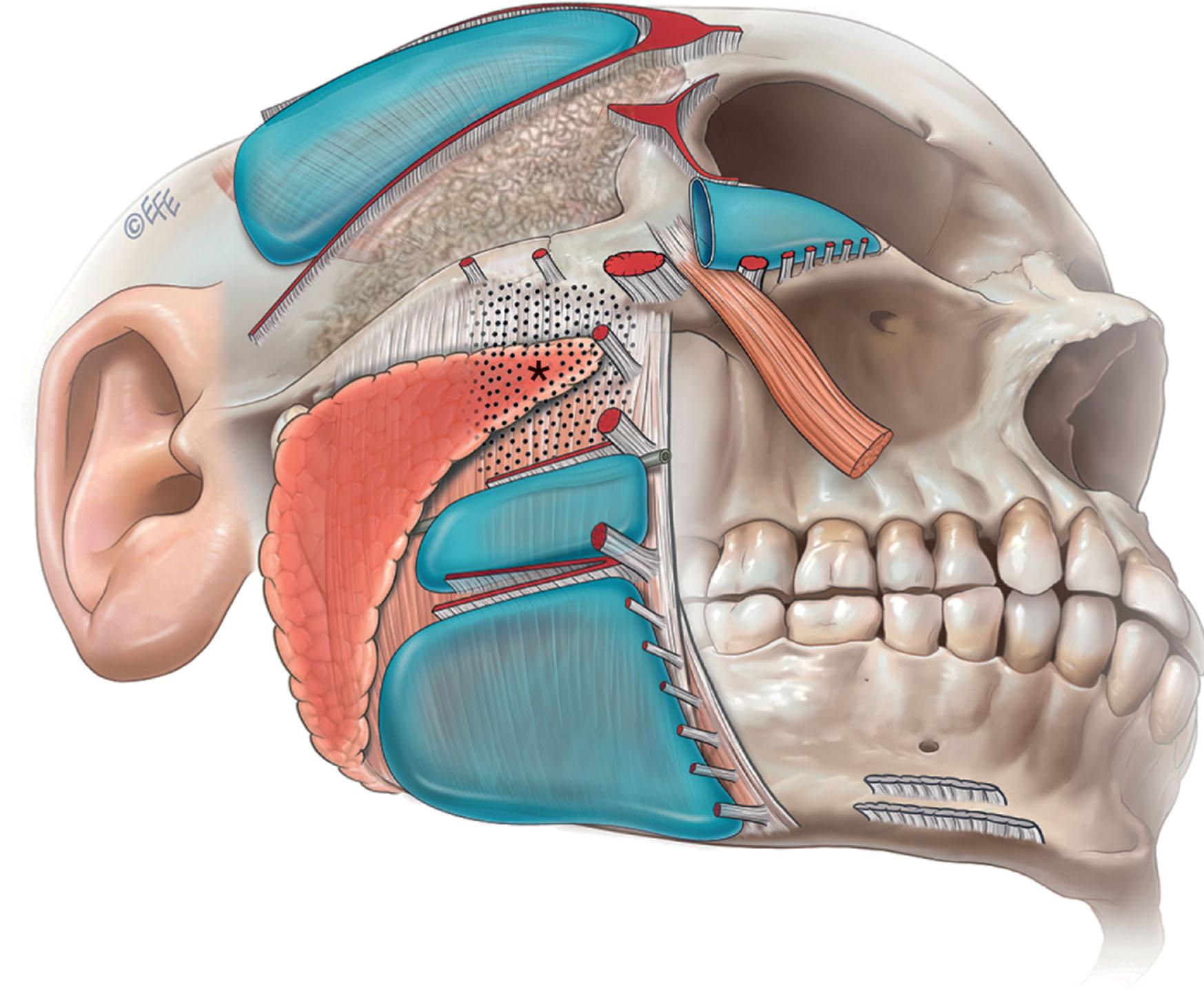 Figure 9.2.6, Topographical anatomy of layer 4 over the lateral face. Spaces (blue), ligaments (red) and areas of important anatomy (stippled). The vertical line of masseteric retaining ligaments demarcates the transition between the stable lateral face and the highly mobile anterior face. The spaces over the zygoma and over the masseter allow for intermediate mobility. The triangular-shaped non-space areas, immediately above and below the arch of the zygoma, contain important anatomy; namely, the temporal and zygomatic branches of the facial nerve respectively, which proceed from lateral into the anterior face. The asterisk indicates the uppermost premasseteric area.