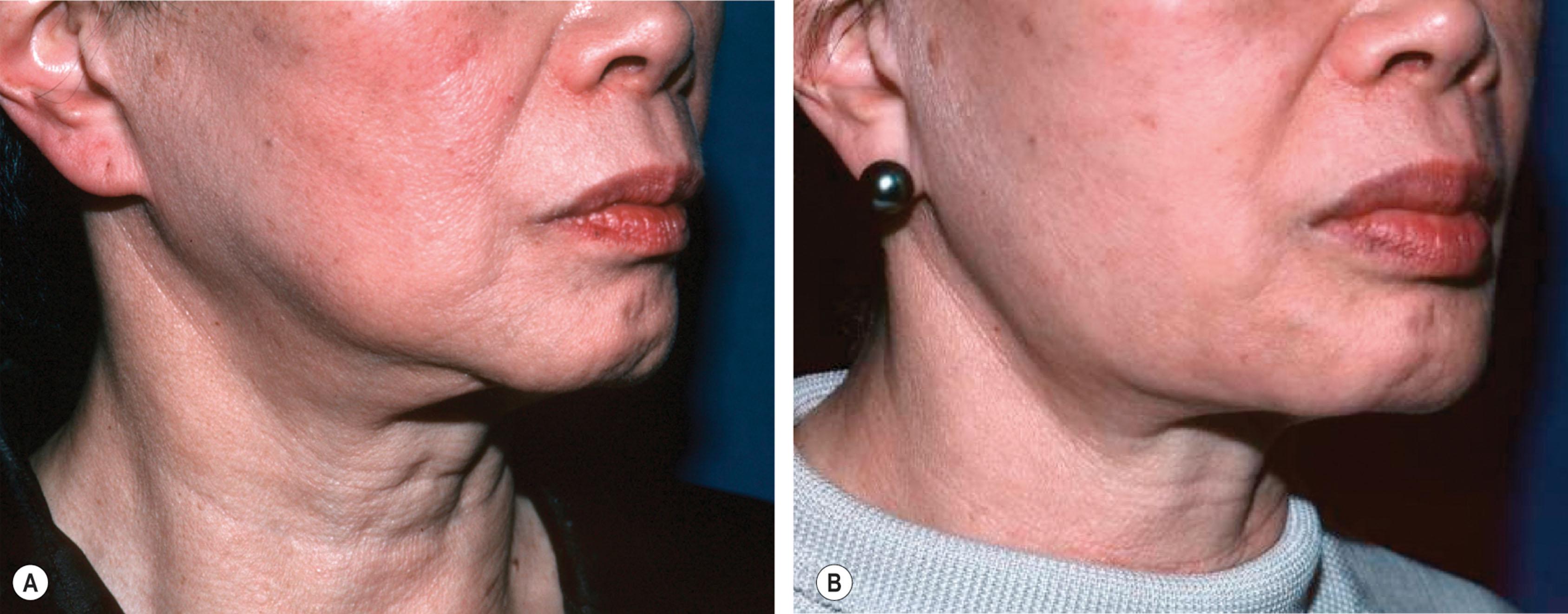 Figure 16.1, (A) The patient preoperatively. (B) Rejuvenation of the jawline and neck was accomplished with placement of structural fat along the border of the mandible back to the angle of the mandible and forward into the chin. Significant augmentation of the lower lip also adds to her improved proportion and rejuvenation.