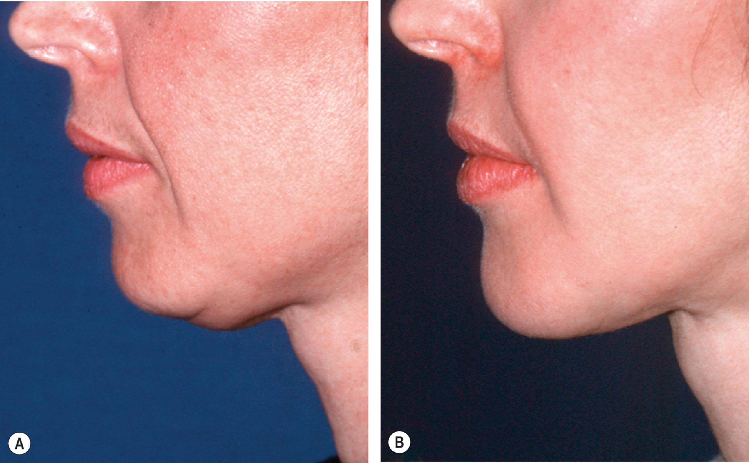 Figure 16.2, The patient (A) before and (B) 6 years after fat grafting to the lower face: 17 cc to chin; 12.5 cc to the left border of the mandible; and 8 cc to the lower lip. Please note that no fat was placed into the upper lip, so the size of the upper lip can be used as a meter to evaluate the degree of change present.