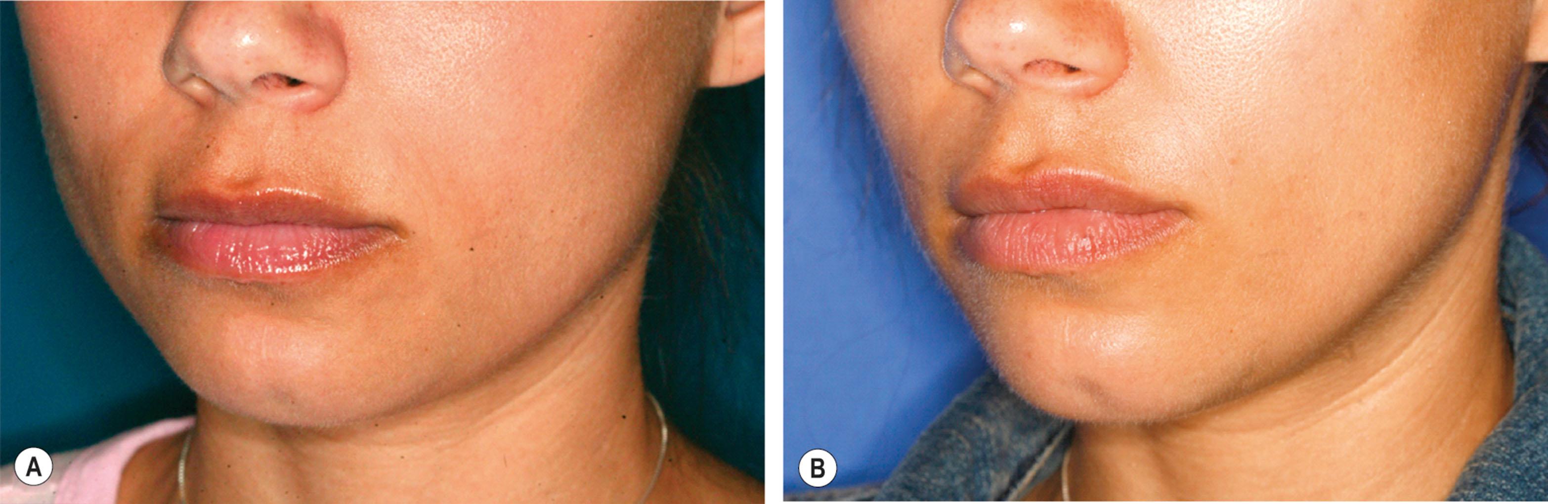Figure 16.3, (A,B) This young woman presented for improved balance of her lower face; 5 cc of fat was placed into her anterior and inferior chin to elongate it. Note that the natural dimple was preserved.