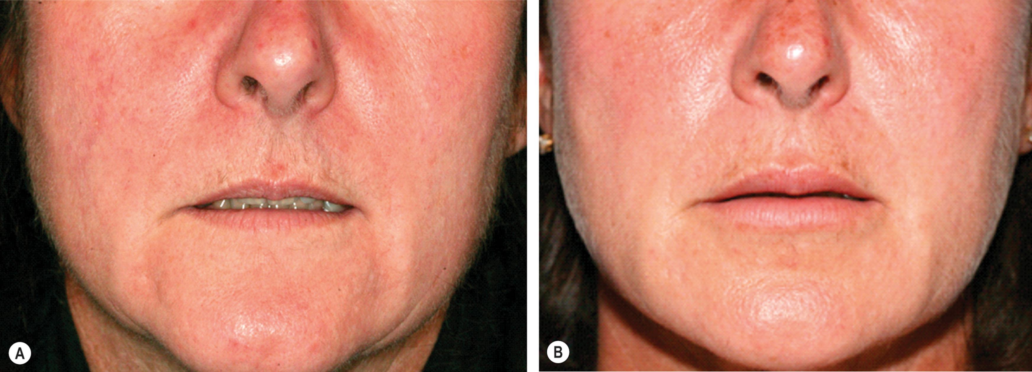 Figure 16.4, This 50-year-old woman had fat grafting to her upper and lower lips in three stages to minimize the postoperative swelling. (A) The patient before and (B) 15 months after her last fat grafting procedure.