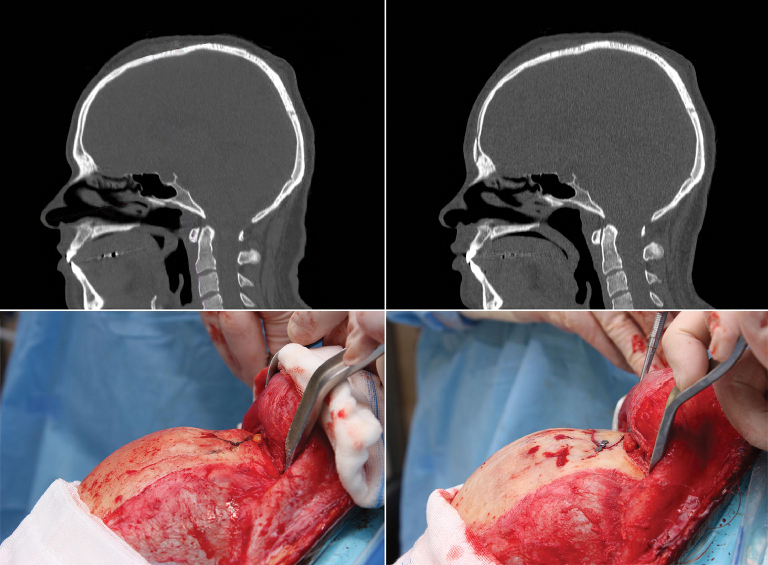 Figure 17.10, Forehead reconstruction in a patient with complete agenesis of the frontal sinus. (Above) Pre- and postoperative sequence with sagittal CT images. (Below) Surgical before and after images of forehead reconstruction with osteotomy of the frontal sinus area. Note the bone fixation method.