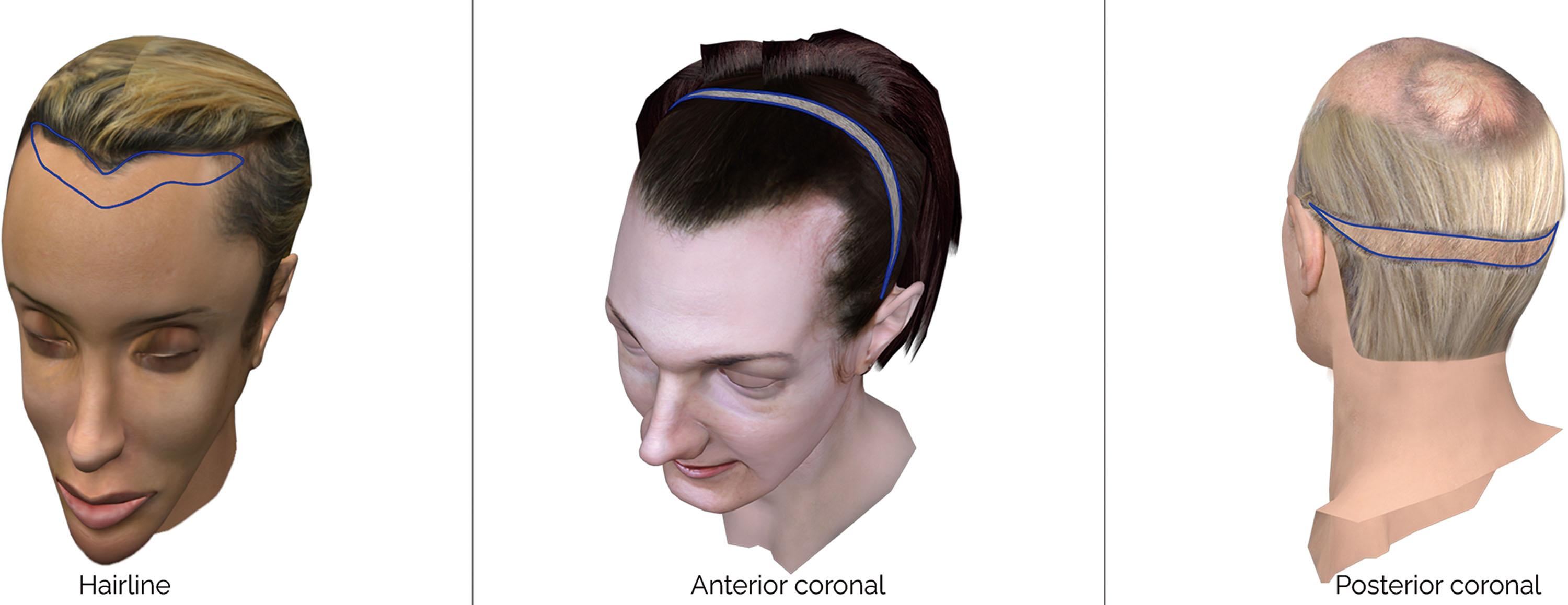 Figure 17.12, Fronto-naso-orbital approach types. From left to right: coronal approach through the hairline, modified coronal approach at the temporoparietal level (anterior coronal), and modified coronal approach at the temporo-parieto-occipital level (posterior coronal).