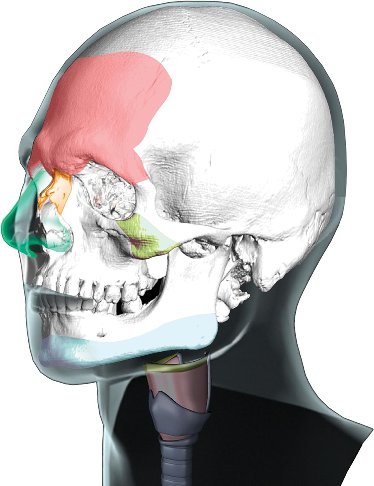 Figure 17.2, Primary aspects related to gender identity. From top to bottom: fronto-naso-orbital complex, frontonasal transition, nose, malar region, lower jaw, and thyroid cartilage.