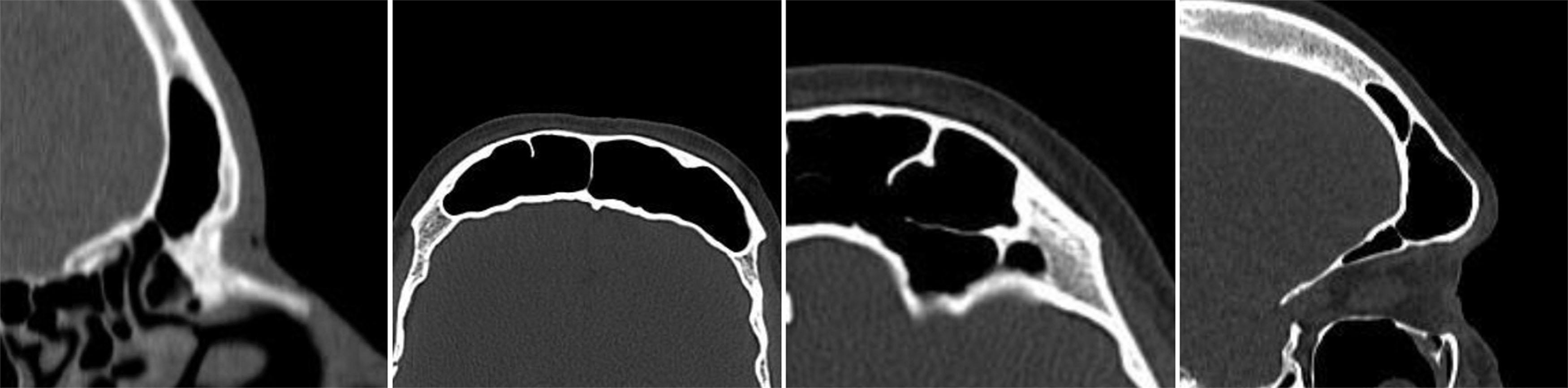 Figure 17.20, Characteristics of the sinus to consider before doing an osteotomy of the anterior wall of the frontal sinus. From left to right: thickness of the anterior wall of the frontal sinus, sinus volume, extension of the sinus towards the lateral areas and orbital ceiling, and sinus projection. To a large extent, these characteristics determine whether the subsequent reconstruction will be simple (screws and titanium plates) or complex (screws and titanium mesh).