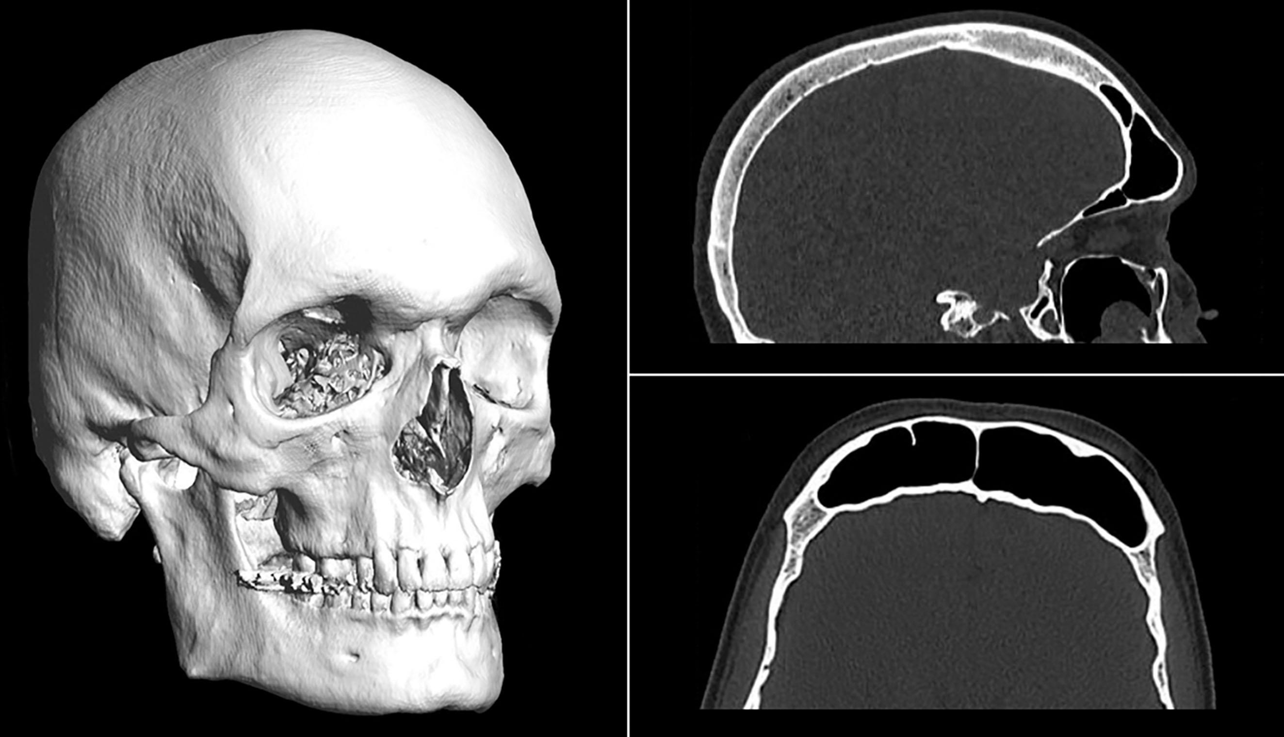 Figure 17.21, Diagnostic tool for preoperative planning: CT study with 3D reconstruction. Note the cranial-caudal and lateral length of the frontal sinus.