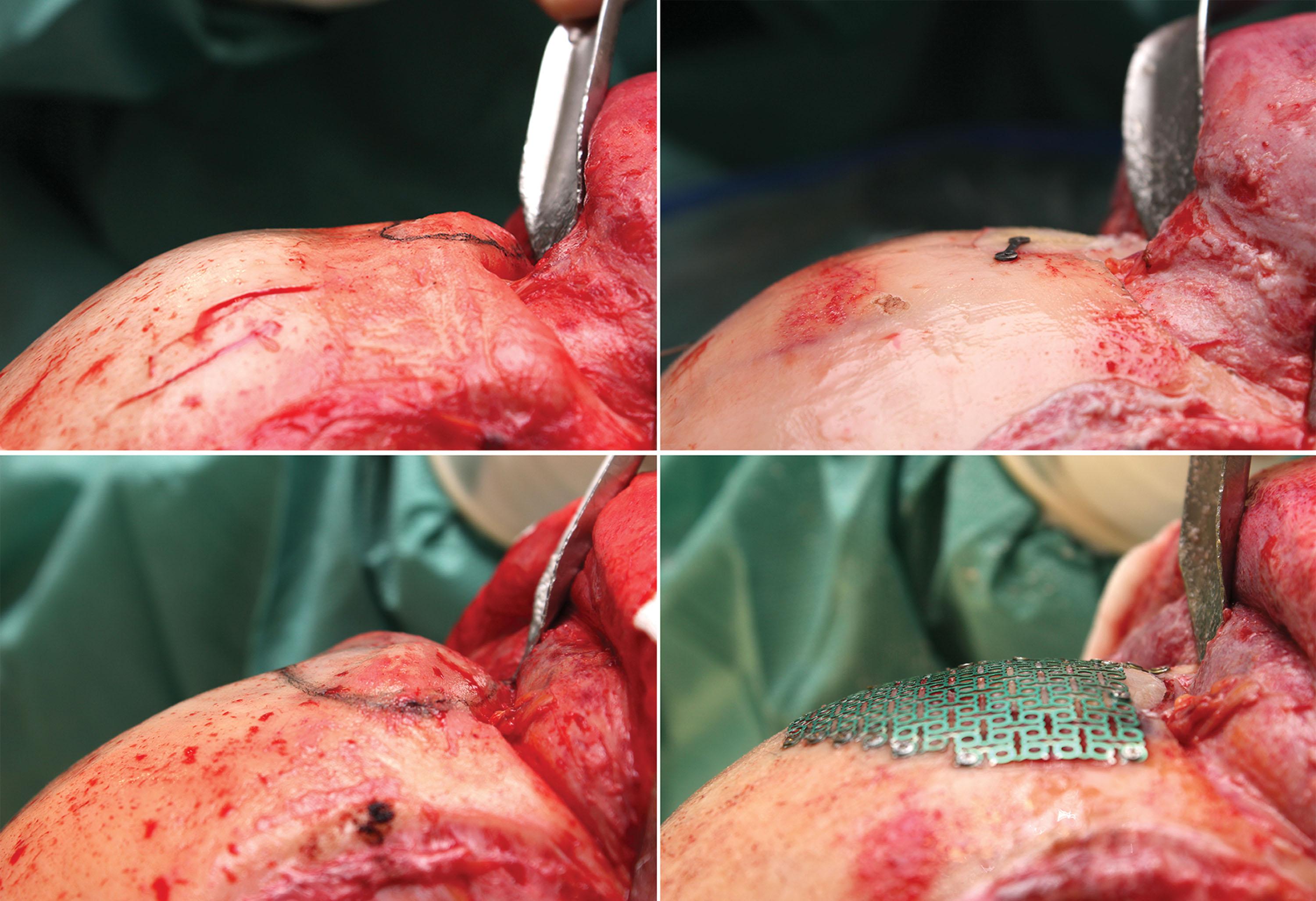 Figure 17.24, Reconstruction of the fronto-naso-orbital region. (Above) Simple reconstruction using osteosynthesis with titanium micro-screws. (Below) Complex reconstruction with titanium mesh.