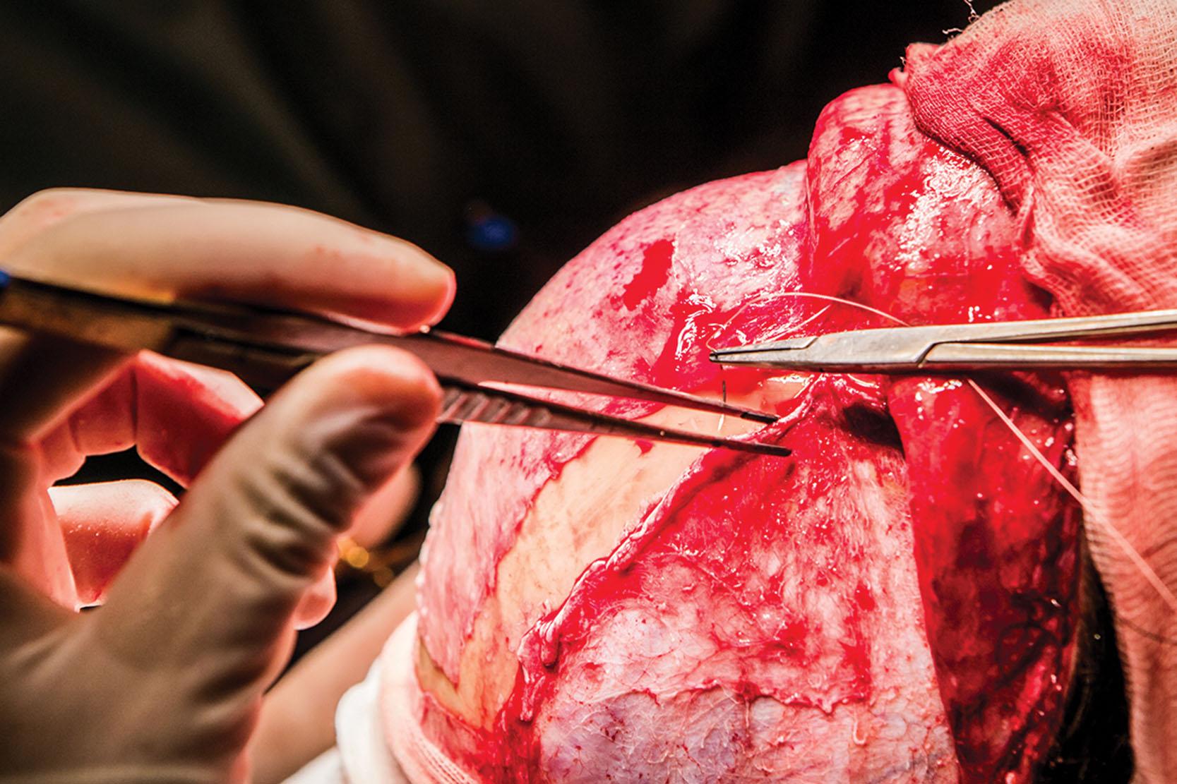 Figure 17.26, Forehead reconstruction technique. Pericranial flap suture.