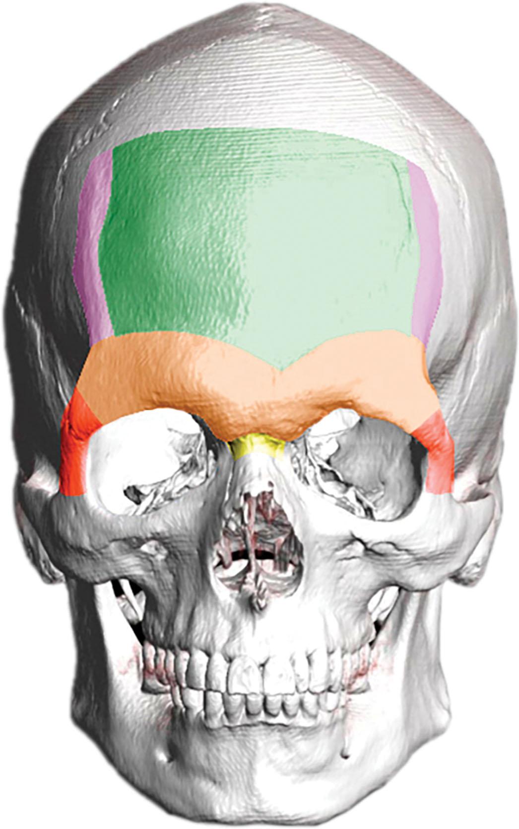 Figure 17.3, Fronto-naso-orbital complex features, color coded. Green: forehead surface; purple: temporal ridges; light orange: supraorbital ridge (including the frontal bossing); dark orange: frontomalar buttresses; yellow: frontonasal transition.