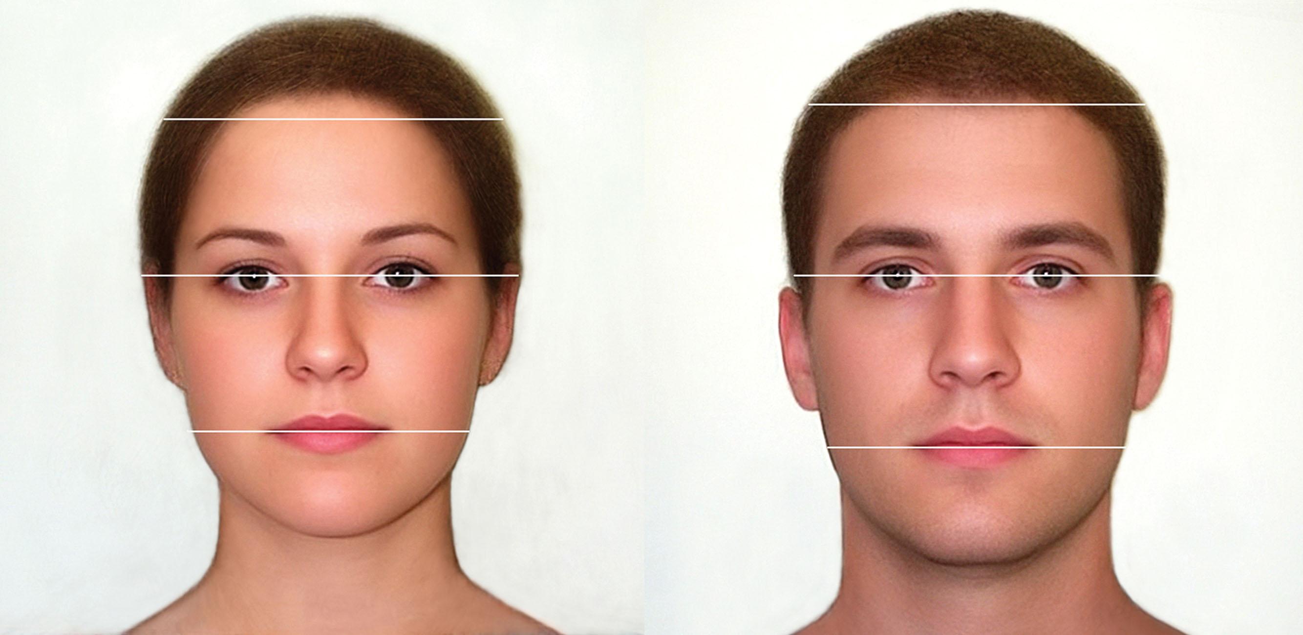 Figure 17.5, Male and female prototypes and the Lipuhai Rule. Prototype of a woman with a rounded hairline and a man with an M-shaped pattern. The Lipuhai Rule states the distance between the interpupillary line and the intercommissural line is applied to the upper facial third. In general, with men it coincides with the hairline, while with women it falls somewhat below.