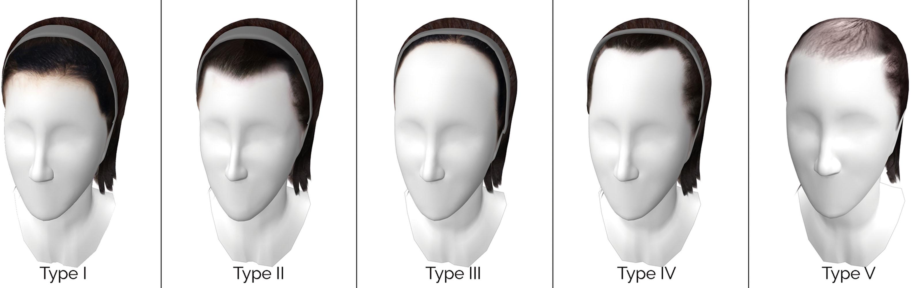 Figure 17.6, Transfeminine hairline types.