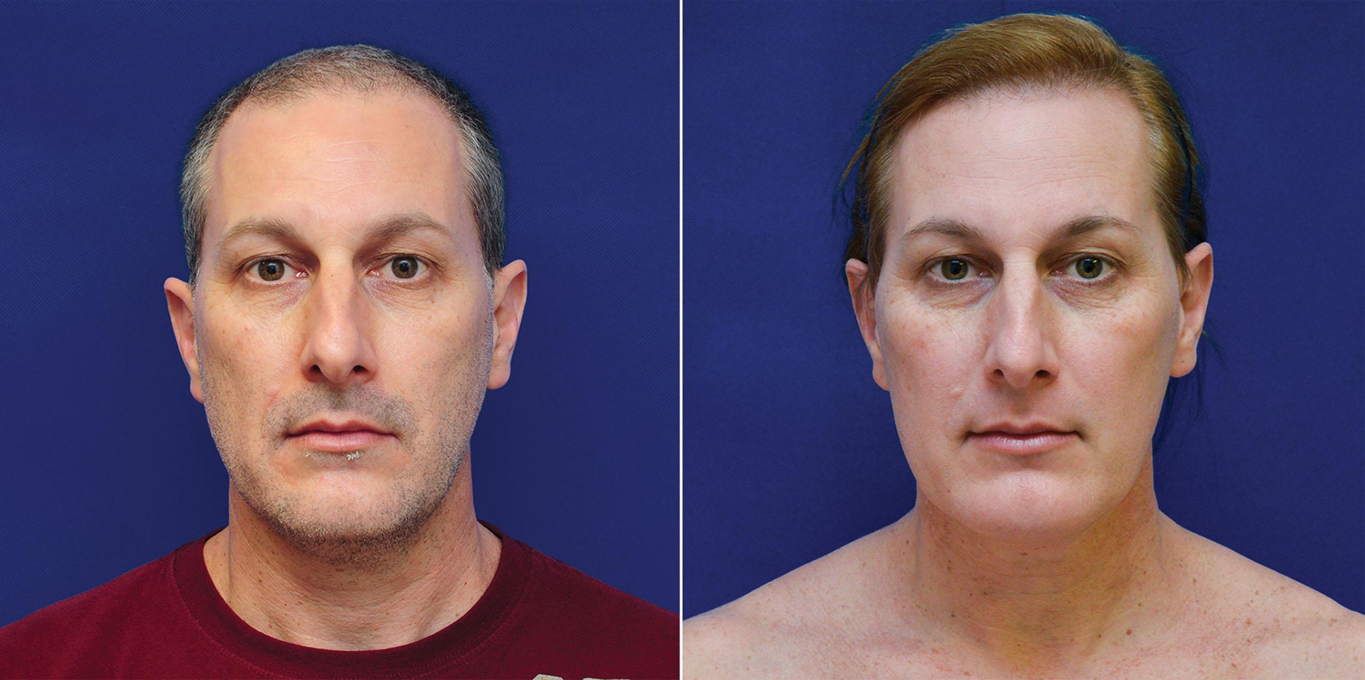 Figure 17.7, Clinical case before and after hormone therapy (HT). (Left) Patient before HT. (Right) Patient after 1 year with HT and before FGCS. Note the change in secondary aspects (hair, facial hair, skin texture, and facial fat) before any type of surgical procedure.