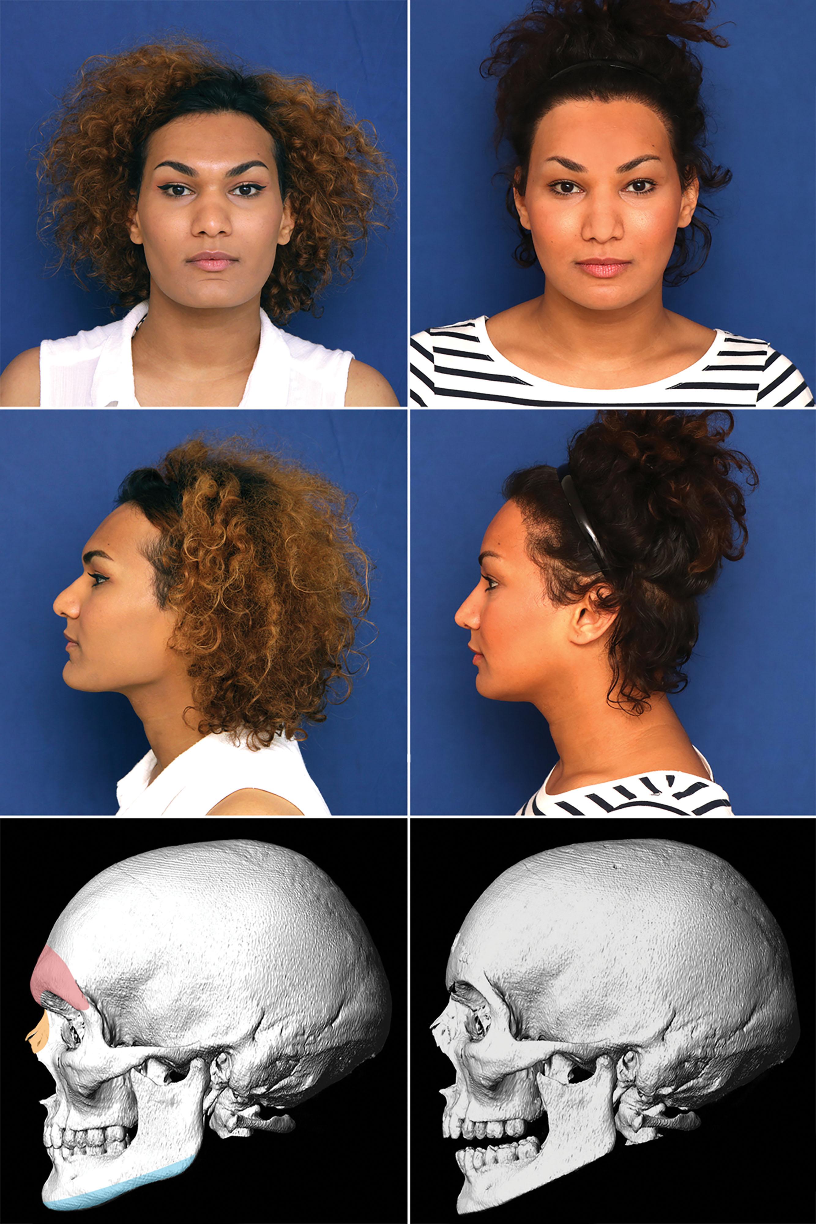 Figure 17.8, Clinical case before and after FGCS with 3D-CT scan study. Note the colored areas indicating the surgical work done. Procedures done: forehead reconstruction and simultaneous hair transplant, rhinoplasty, lower jaw and chin contouring (angle-to-angle ostectomy).