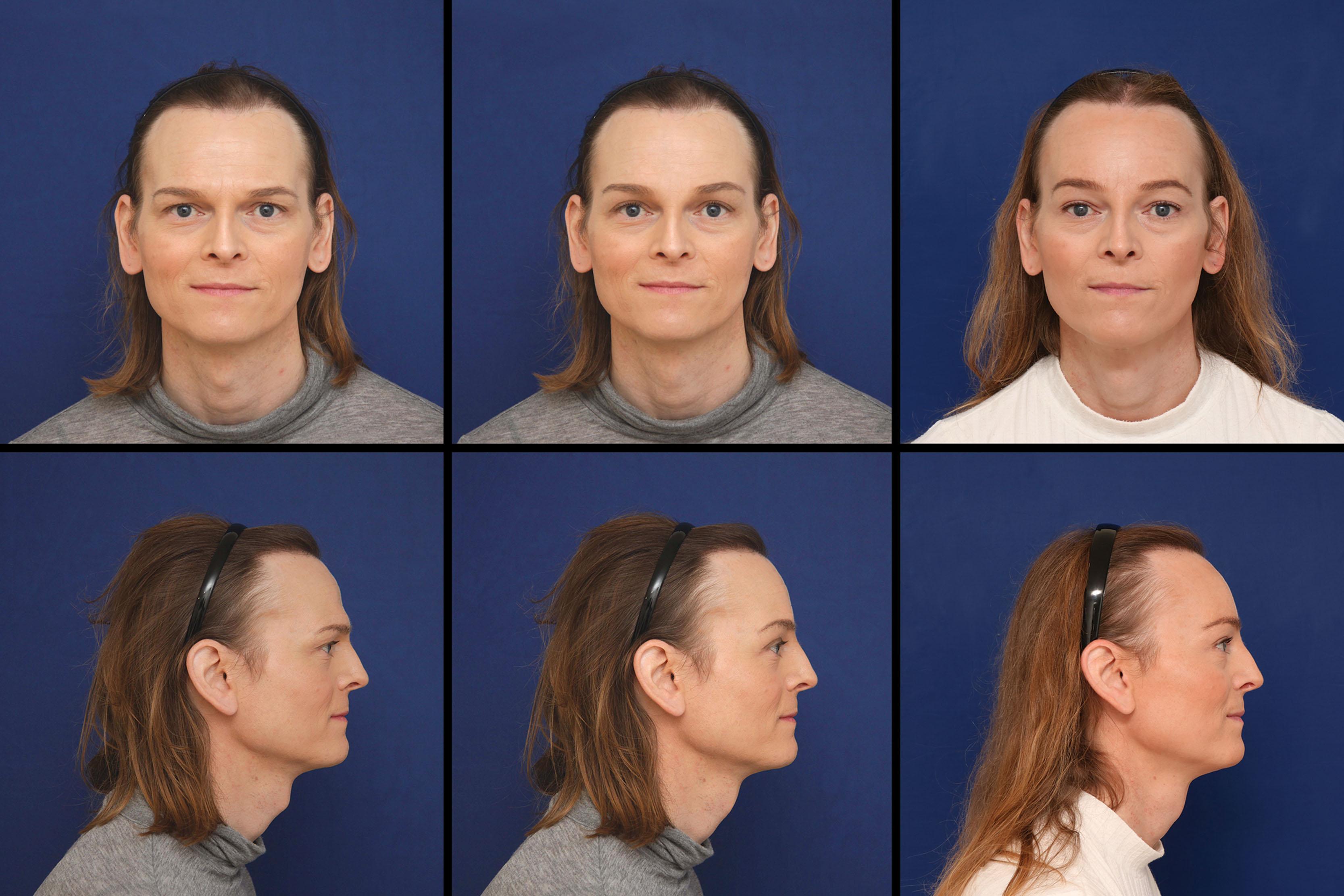 Figure 17.9, Pre-surgical, virtual, and 12-month post-surgical clinical case. (Left) Before. (Center) Virtual simulation. (Right) After. Procedures done: forehead reconstruction by coronal approach, Adam’s apple contouring.