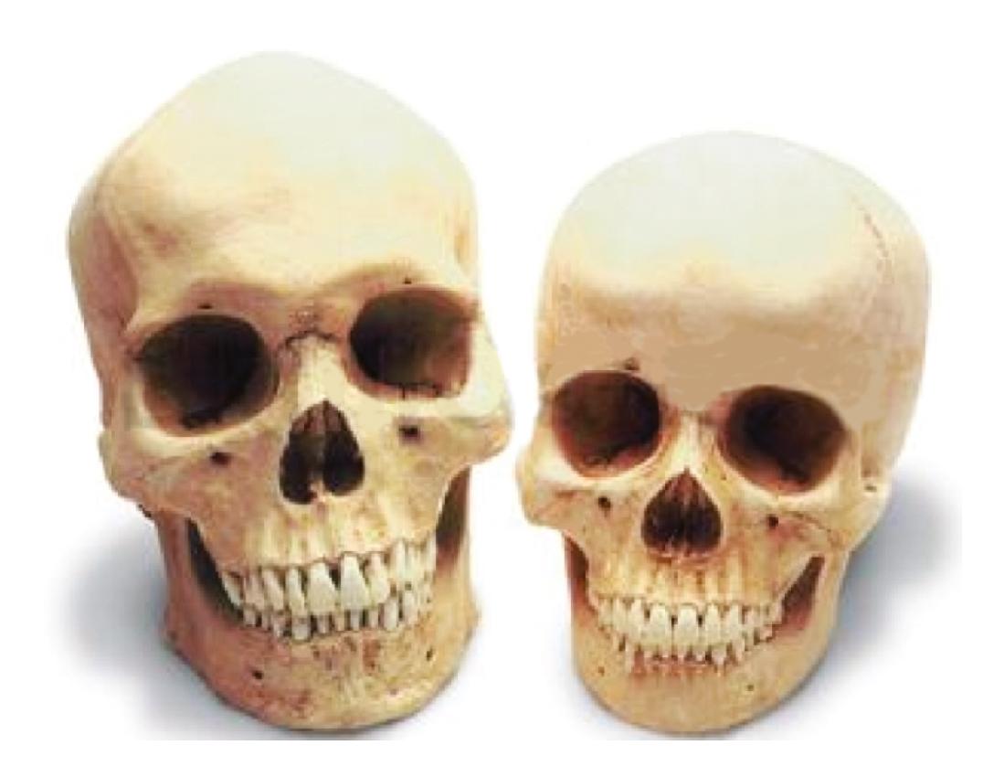 Fig. 40.1, Male versus female skulls. The male skull is more rectangular and has a vertically longer chin, whereas the female skull is more oval in shape and has a more pointed chin. The male skull also has a wider, fuller jaw. The male skull has a pronounced brow ridge, whereas the female skull has a more rounded, smooth forehead that does not project over the eyes. The male also has a taller, angular jawbone; the female has a shorter, tapered jawbone.