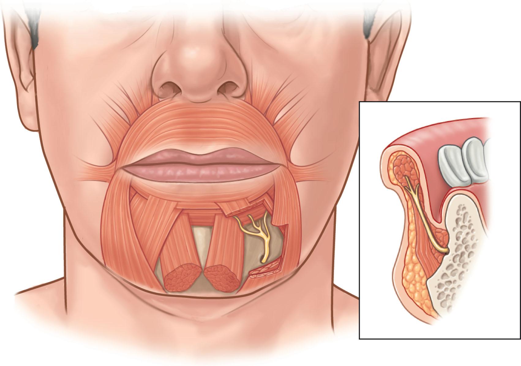 Figure 15.3, The depressor anguli oris can be seen in the corner of the mouth. Muscle contraction pulls the corner of the mouth down as in the expression of sadness. The depressor labii inferioris goes into the orbicularis oris of the mid lateral portion of the lower lip and pulls the lip down. The muscle’s function is apparent in an open-mouth smile showing the lower teeth. The mental nerve lies on the deep surface of the depressor labii inferioris.