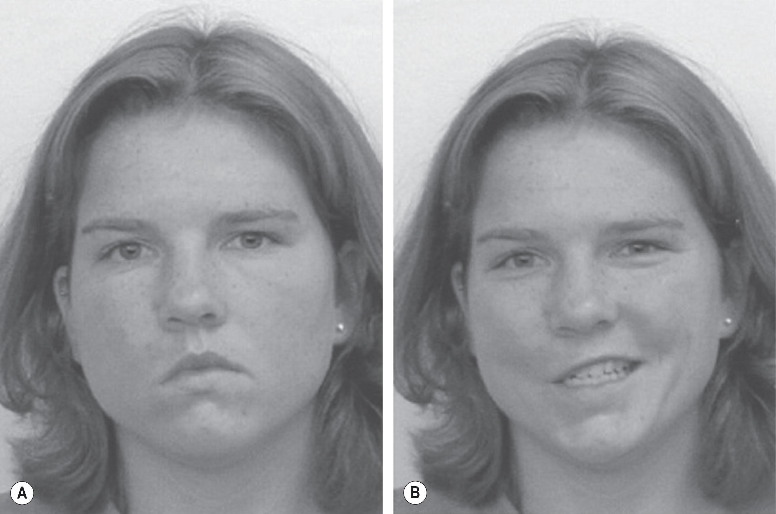 Figure 15.5, (A) At rest, the right-sided partial facial paralysis in this young woman is minimally evident, as seen by a slight deviation of the mouth to her left and a slightly wider palpebral aperture in her right eye. (B) With smiling, the asymmetry becomes more apparent.