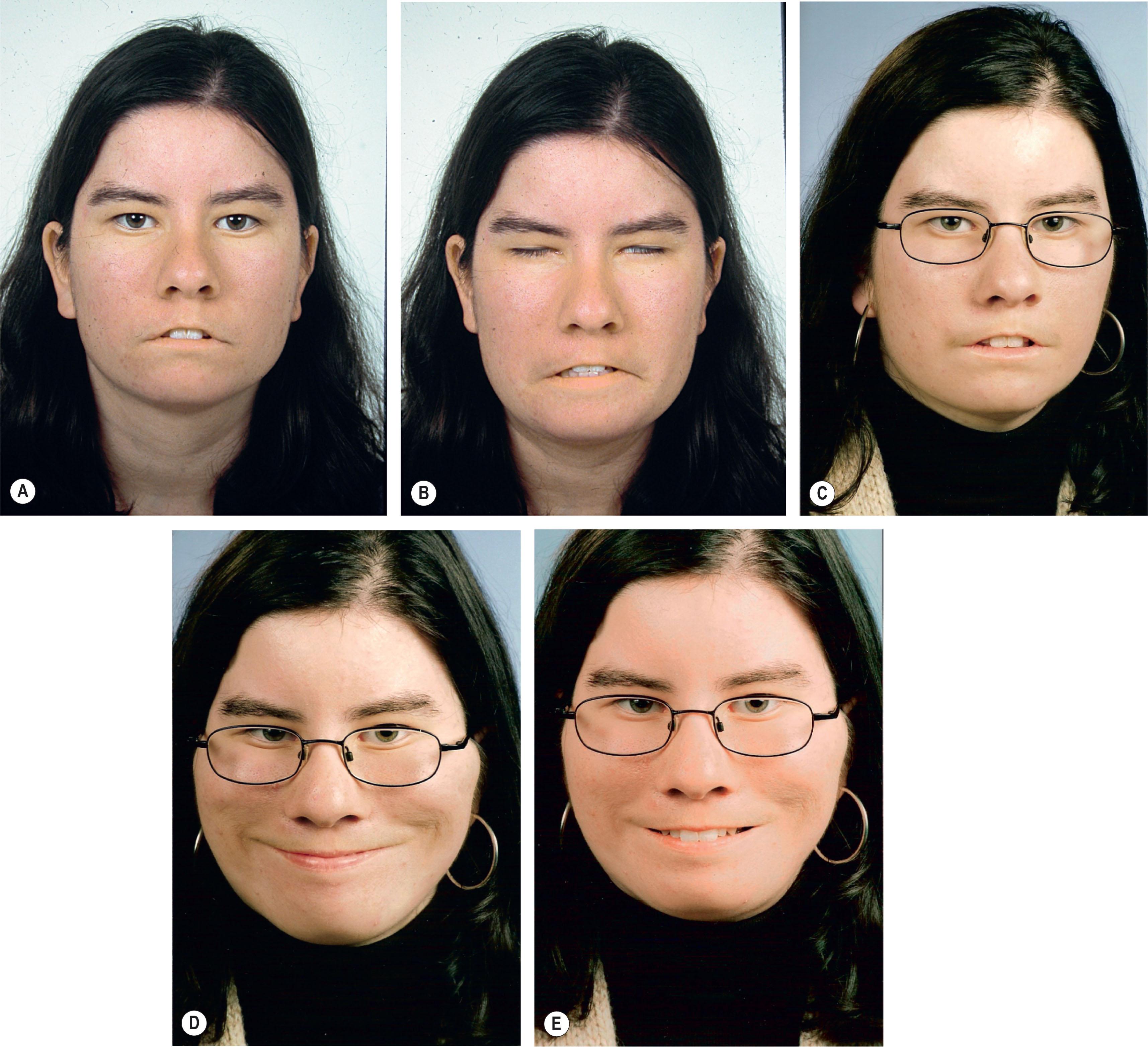 Figure 15.25, (A) Preoperative views of a patient with Moebius syndrome at rest and (B) with maximum animation. (C) Postoperative view at rest after motor nerve to masseter powered free functioning muscle transplantation to the lower face. (D) Patient with closed-mouth smile. (E) Patient smiling and showing teeth.