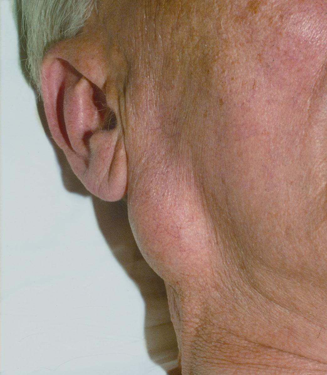 Figure 19, Pleomorphic adenoma (benign) of the parotid gland .