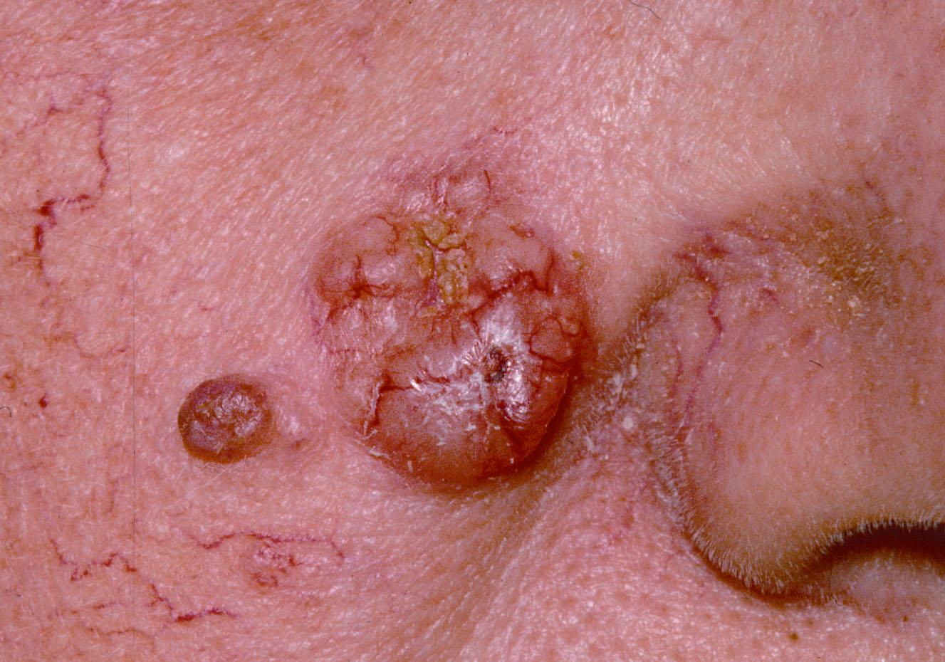 Figure 20, The larger nodular lesion on the cheek is a typical basal cell carcinoma .