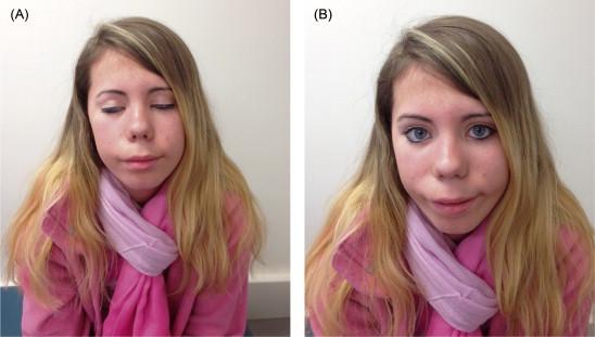 Figure 32.1, A patient with FSHD. ( A ) illustrates the inability to bury the eyelashes upon eye closure and ( B ) demonstrates the overt facial weakness, horizontal smile, and the dimpling on either side of the face upon attempting to smile.