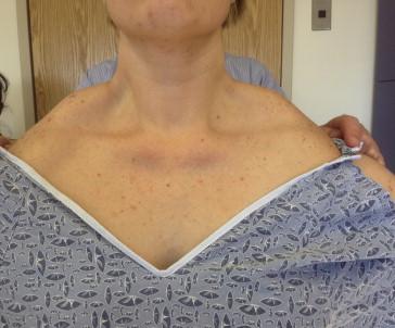 Figure 32.2, This figure illustrates the hypertrophic appearance of the trapezius, which becomes apparent when shoulder abduction is attempted.