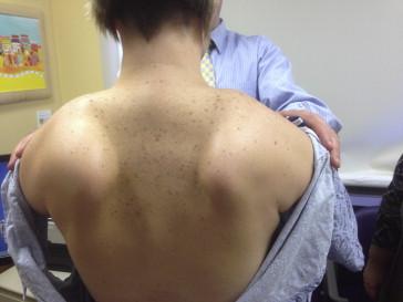 Figure 32.3, Scapular winging is seen in this patient with FSHD, with the scapulae rising upwards and laterally, and jutting out posteriorly of the inferomedial corners.