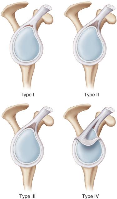 FIG. 50.1, SLAP Tear Classification, type’s I-IV. Type I lesions have degeneration or fraying of the superior labrum, but the biceps tendon remains attached at its insertion. Type II lesions demonstrate detachment of the superior labrum from the glenoid. Type III lesions are characterized by a bucket handle tear of the superior labrum, but the biceps tendon and labral rim attachment remain intact. Type IV lesions are characterized by a detachment of the superior labrum with a tear also extending into the biceps tendon.